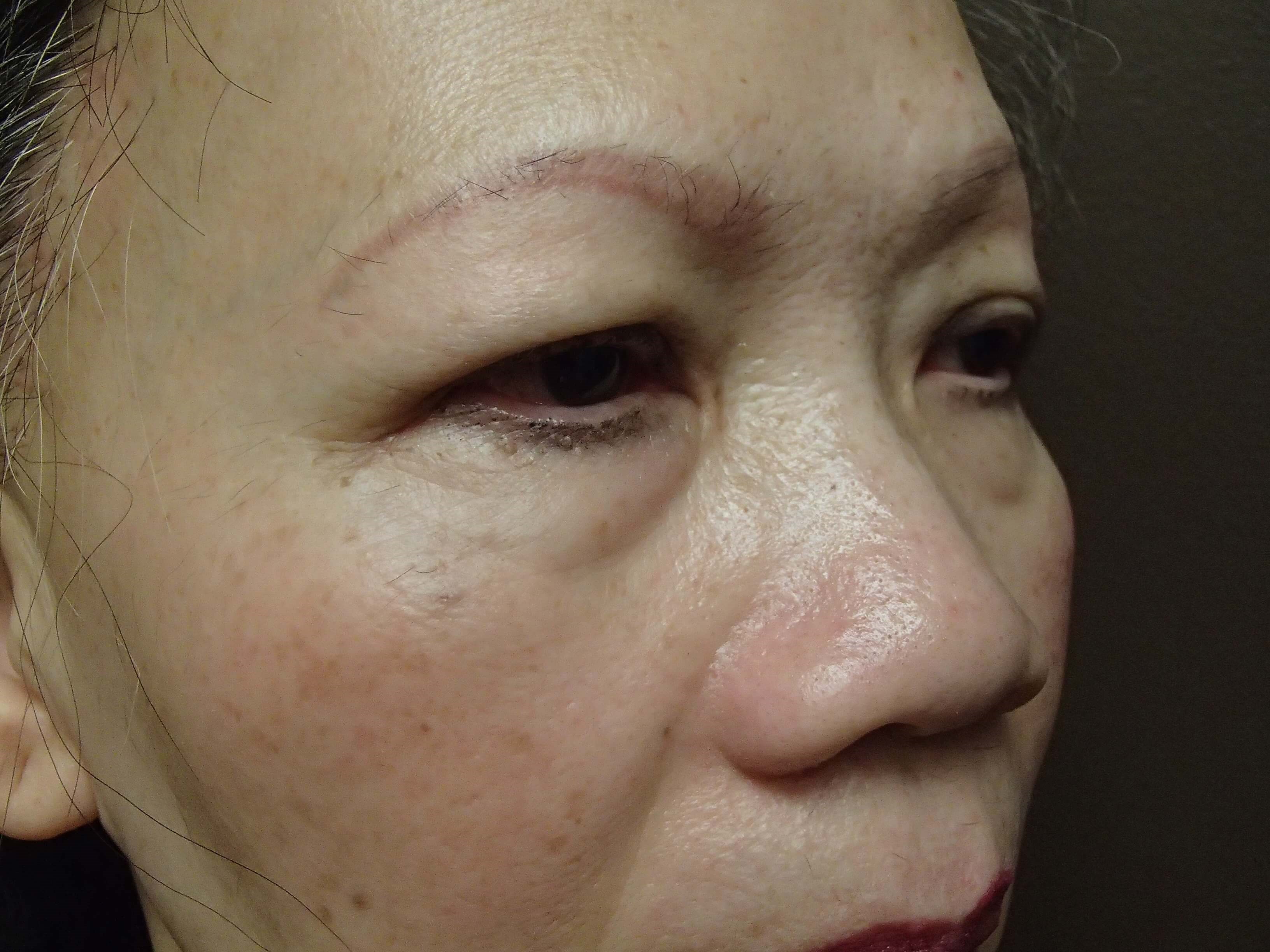 Blepharoplasty Before