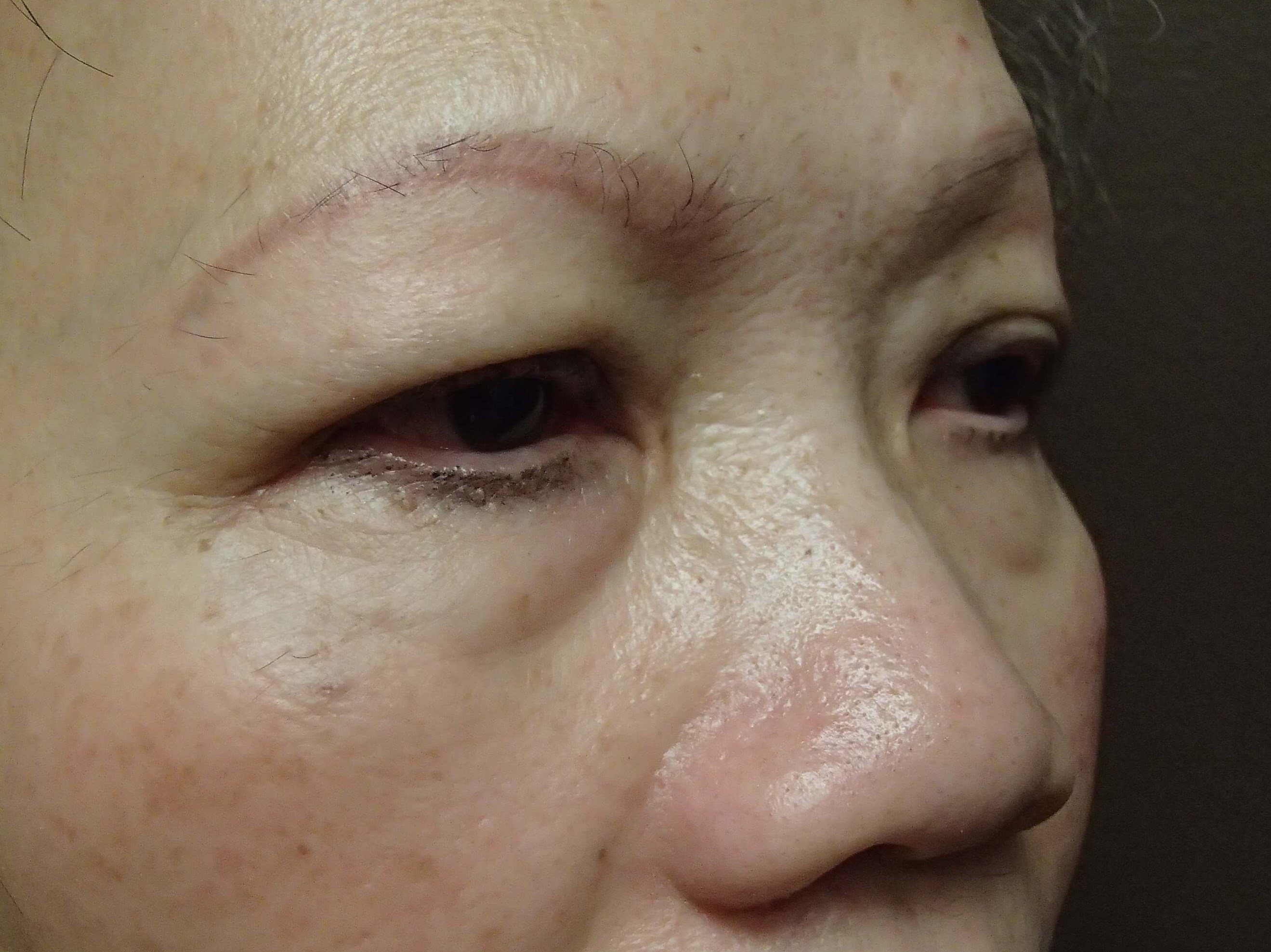 Blepharoplasty Before