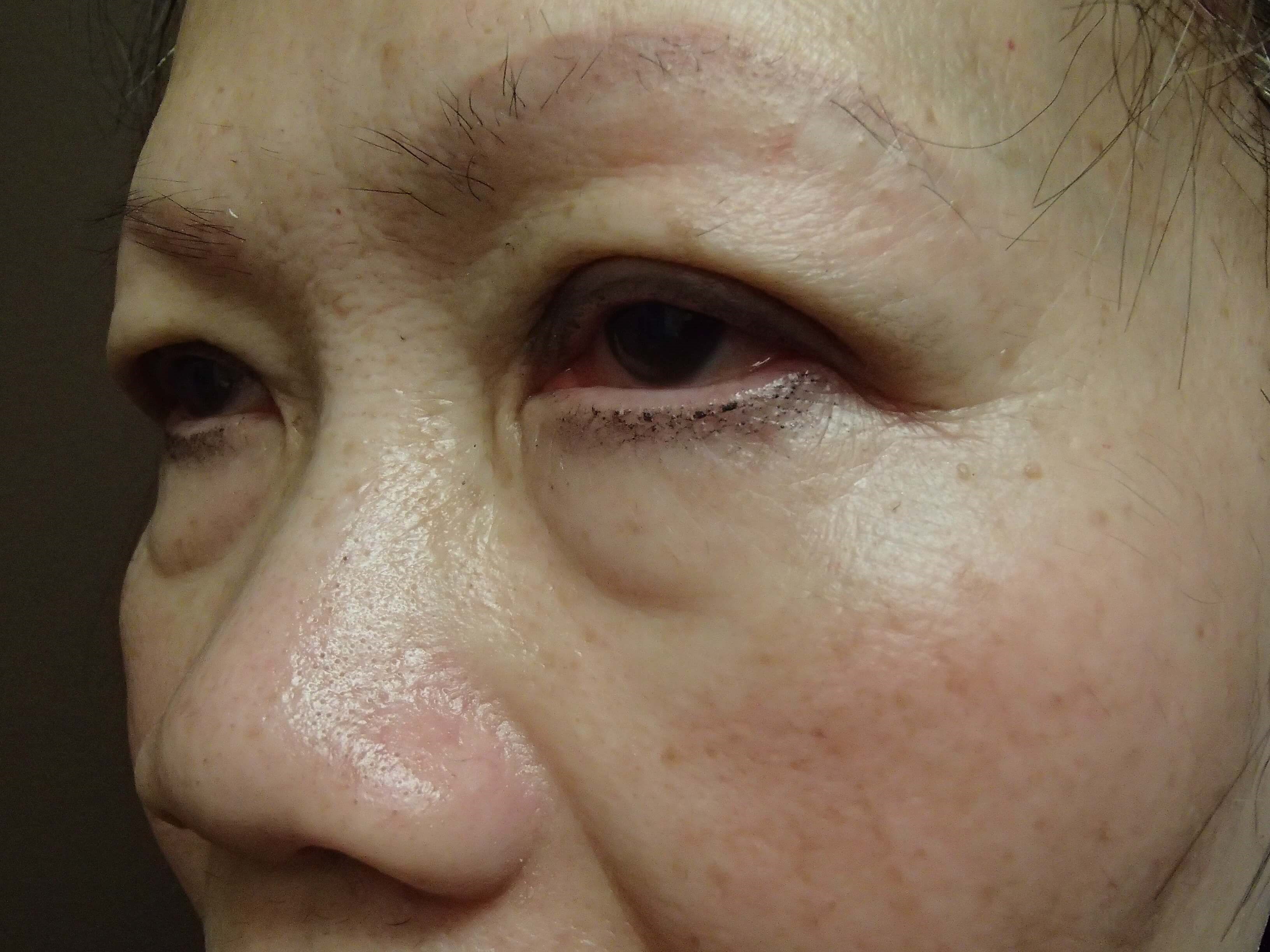 Blepharoplasty Before