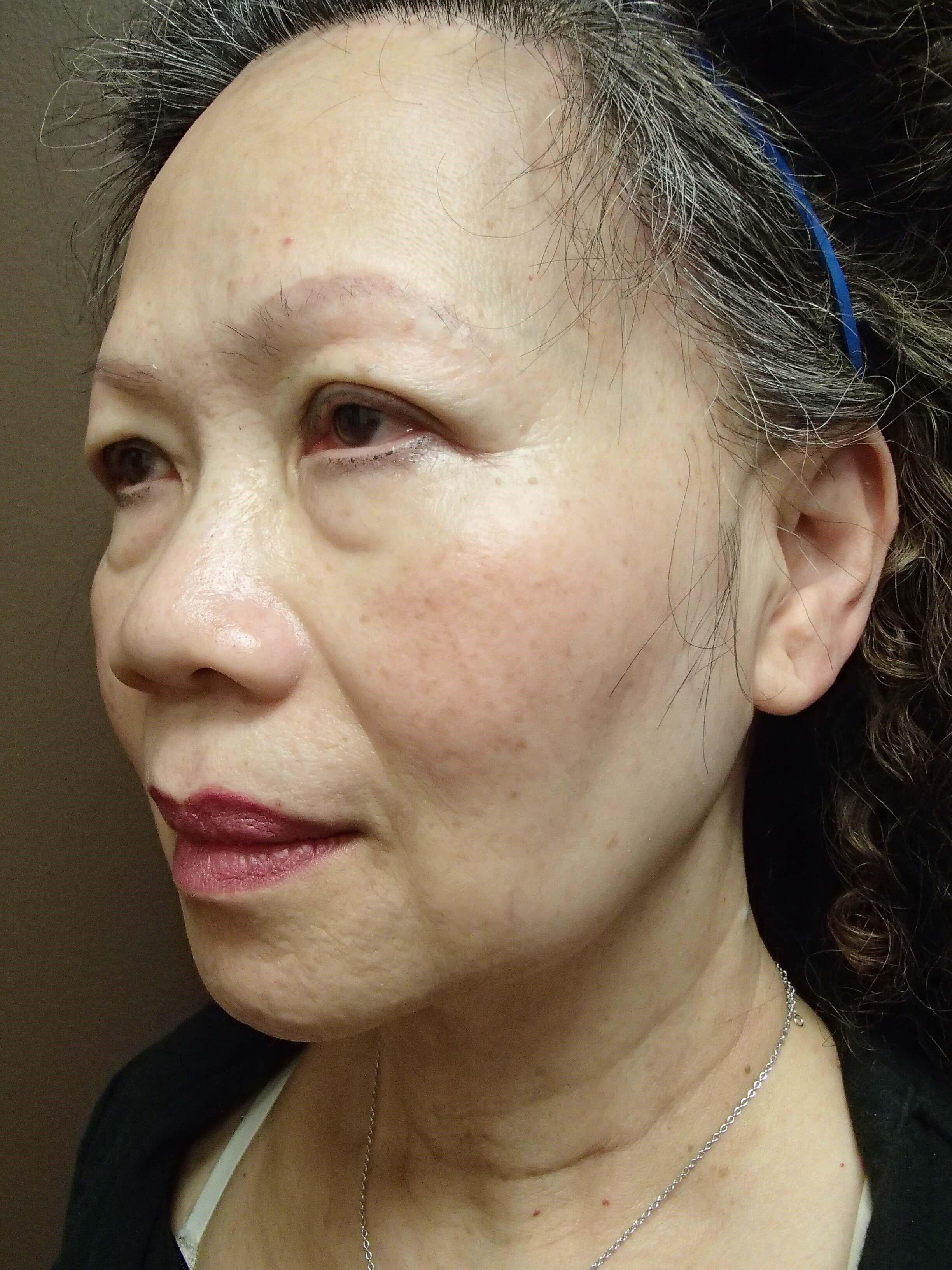 Facelift with Necklift Before