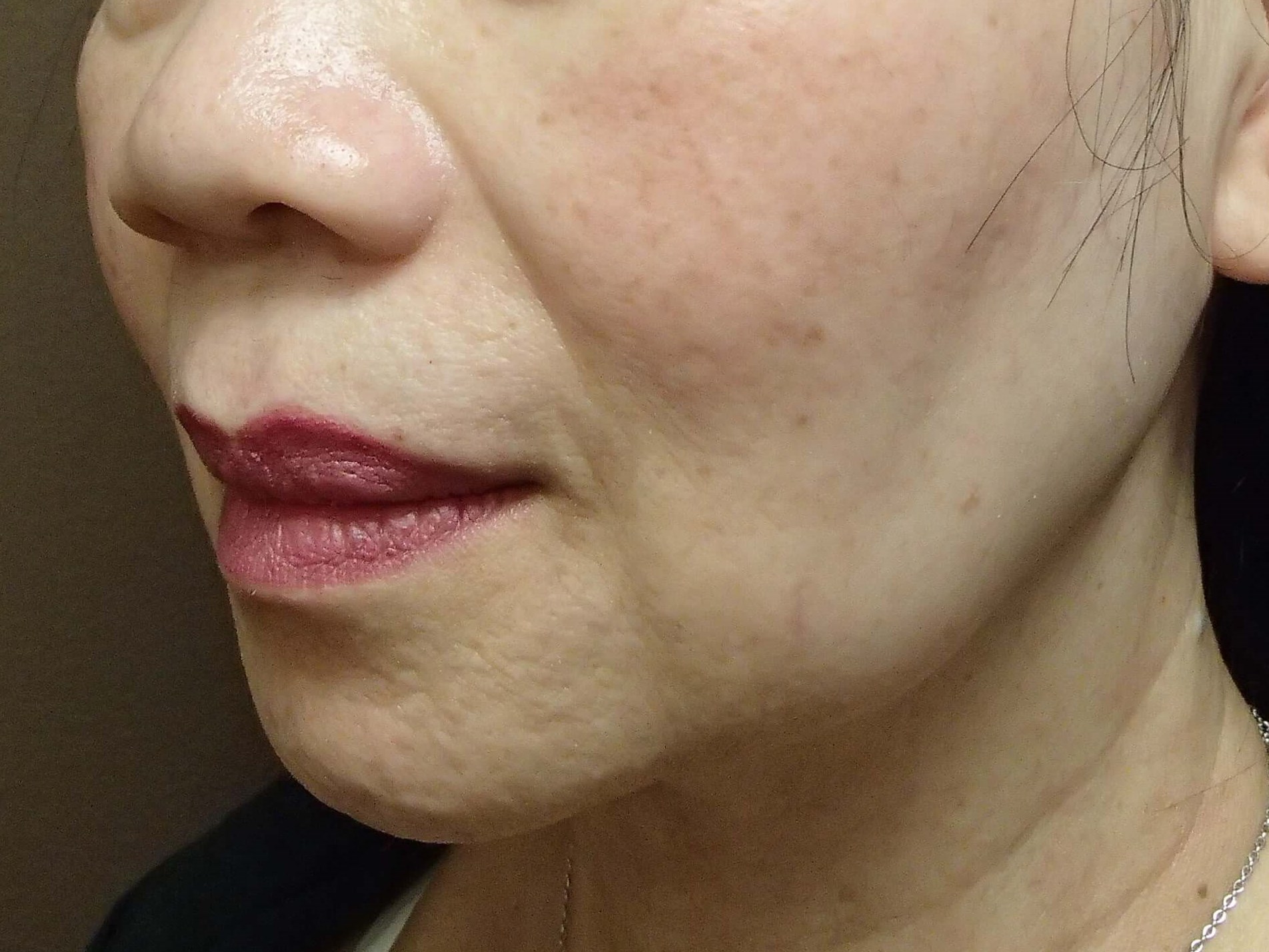 Facelift with Necklift Before