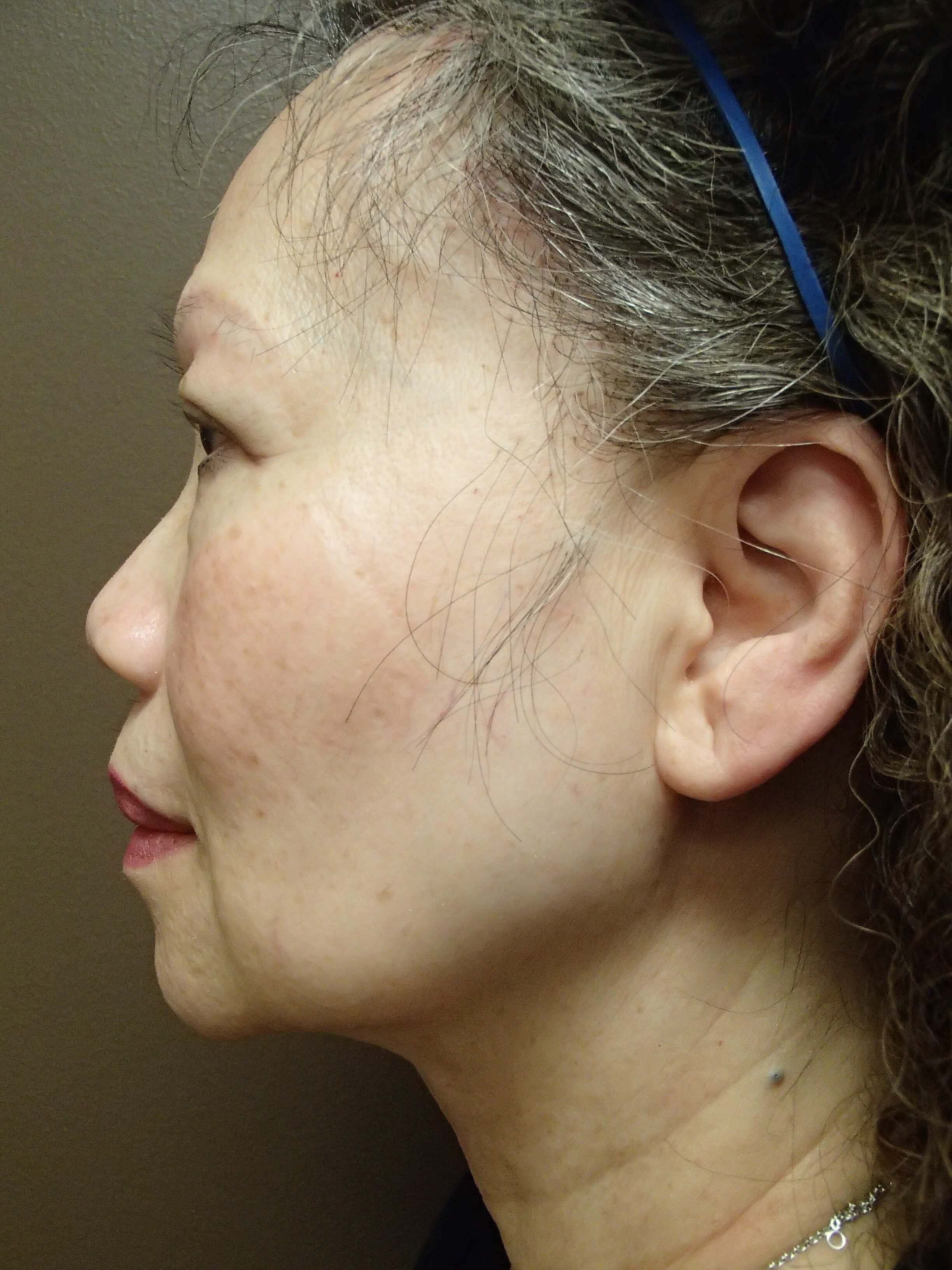 Facelift with Necklift Before