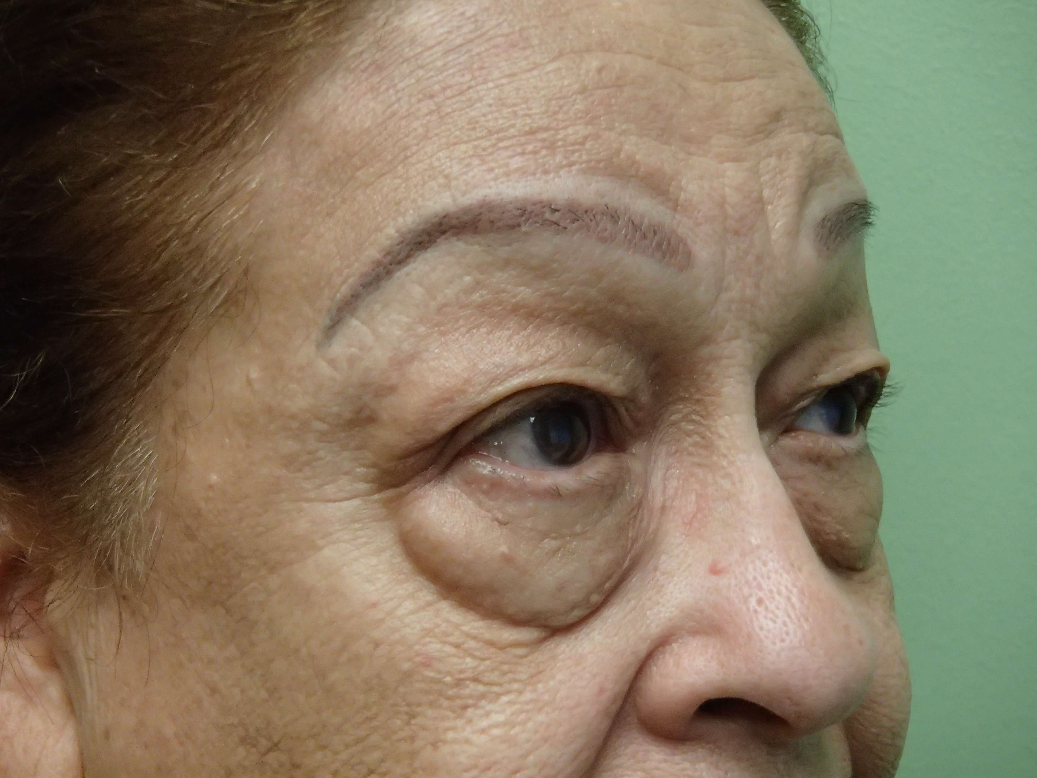 Blepharoplasty Before