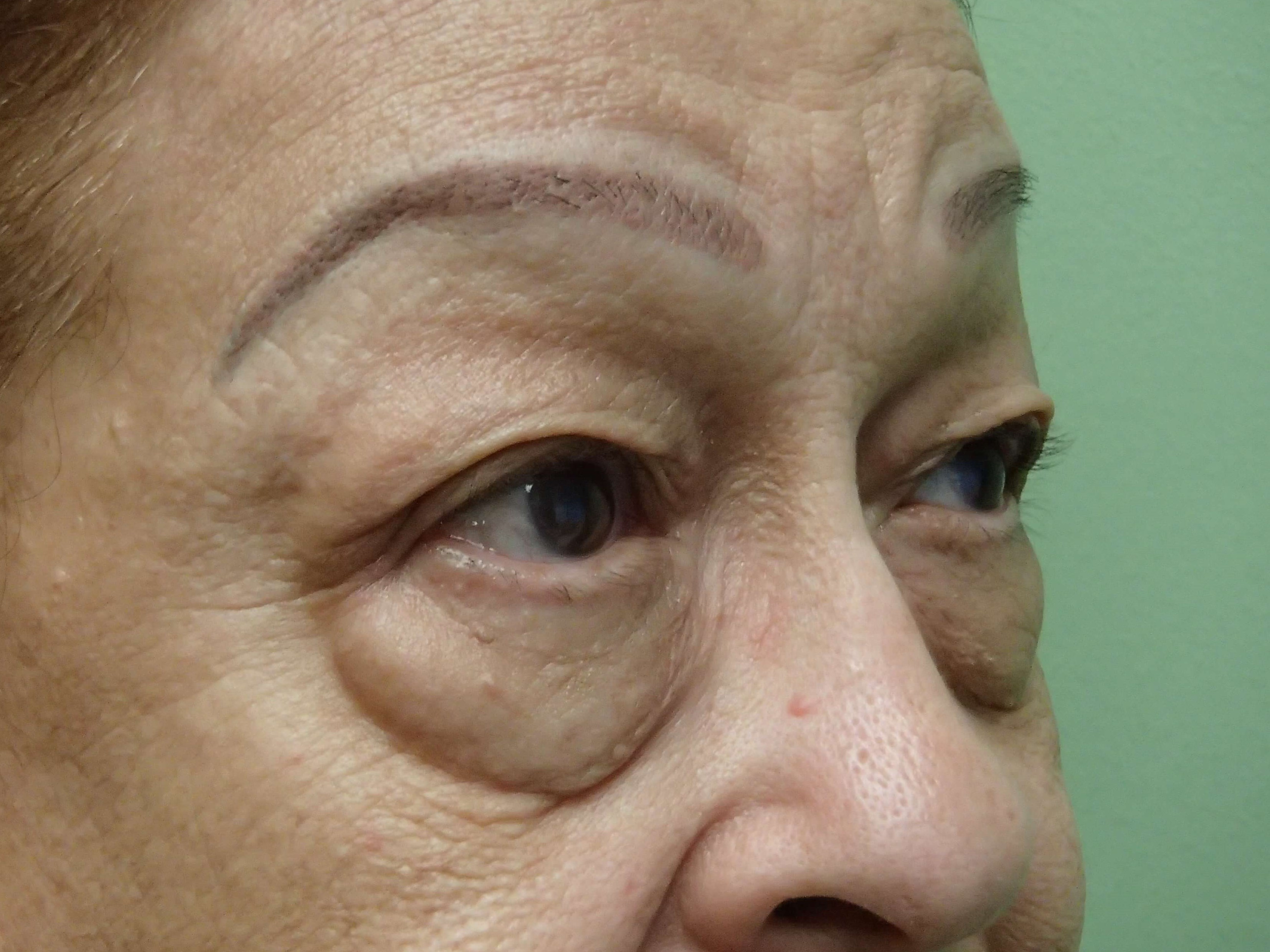 Blepharoplasty Before