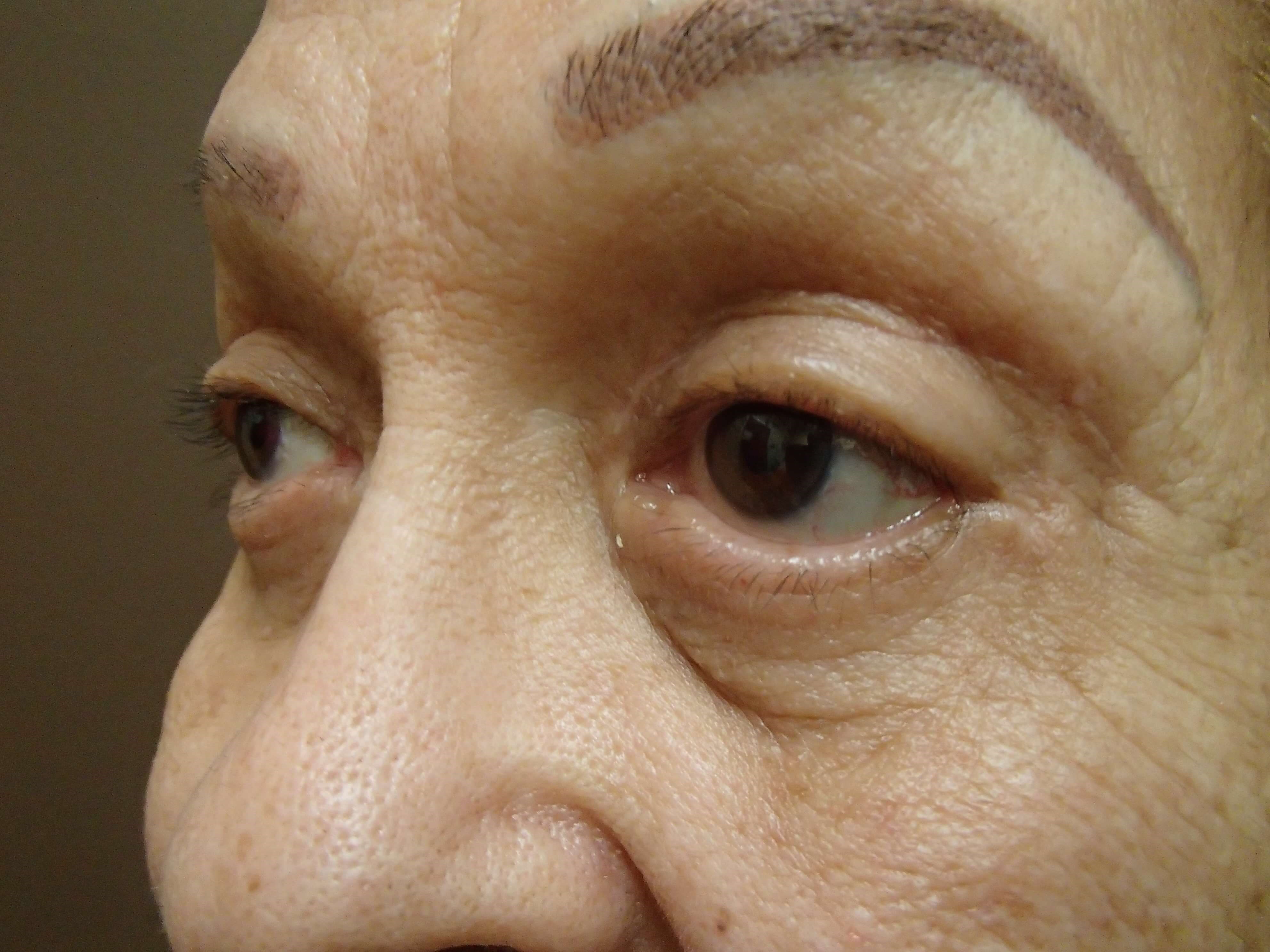 Blepharoplasty After