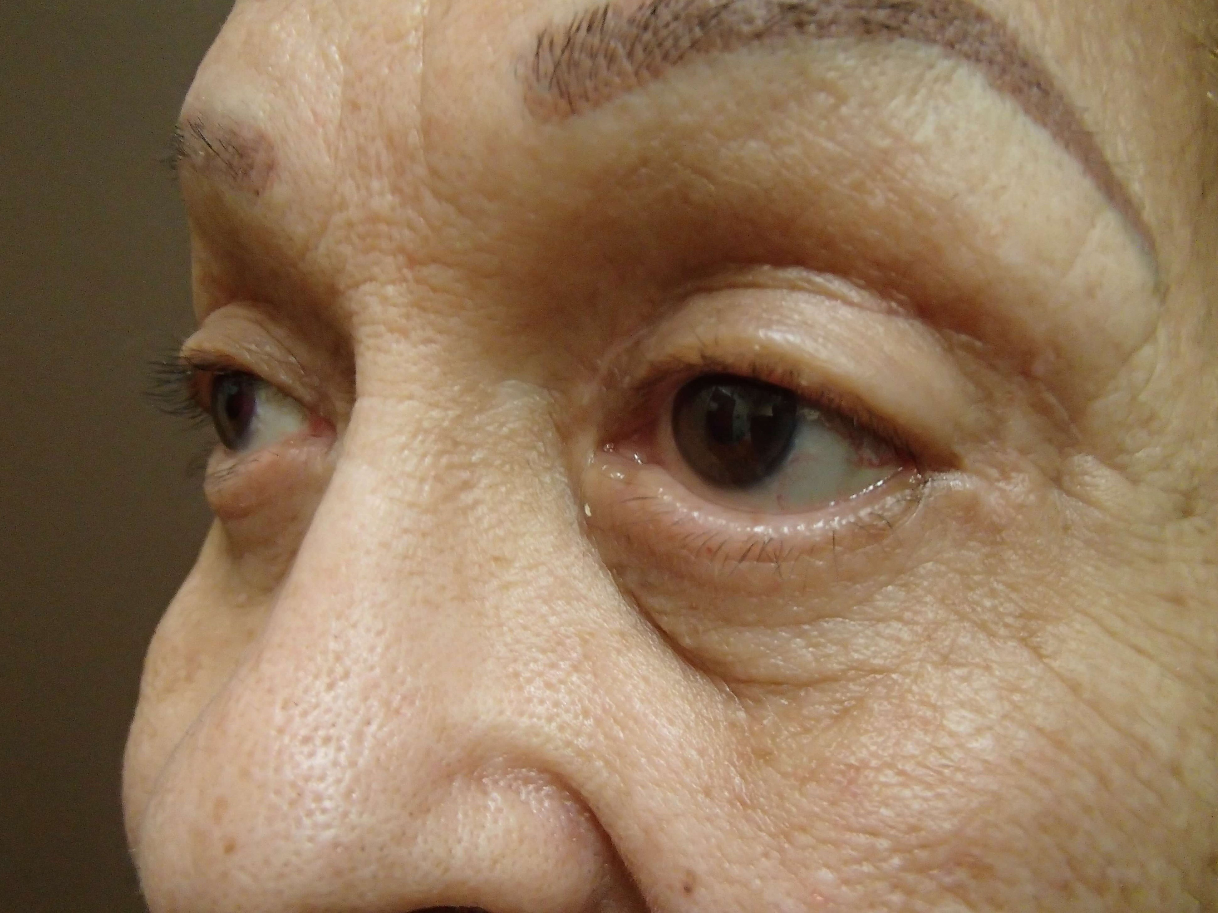 Blepharoplasty After