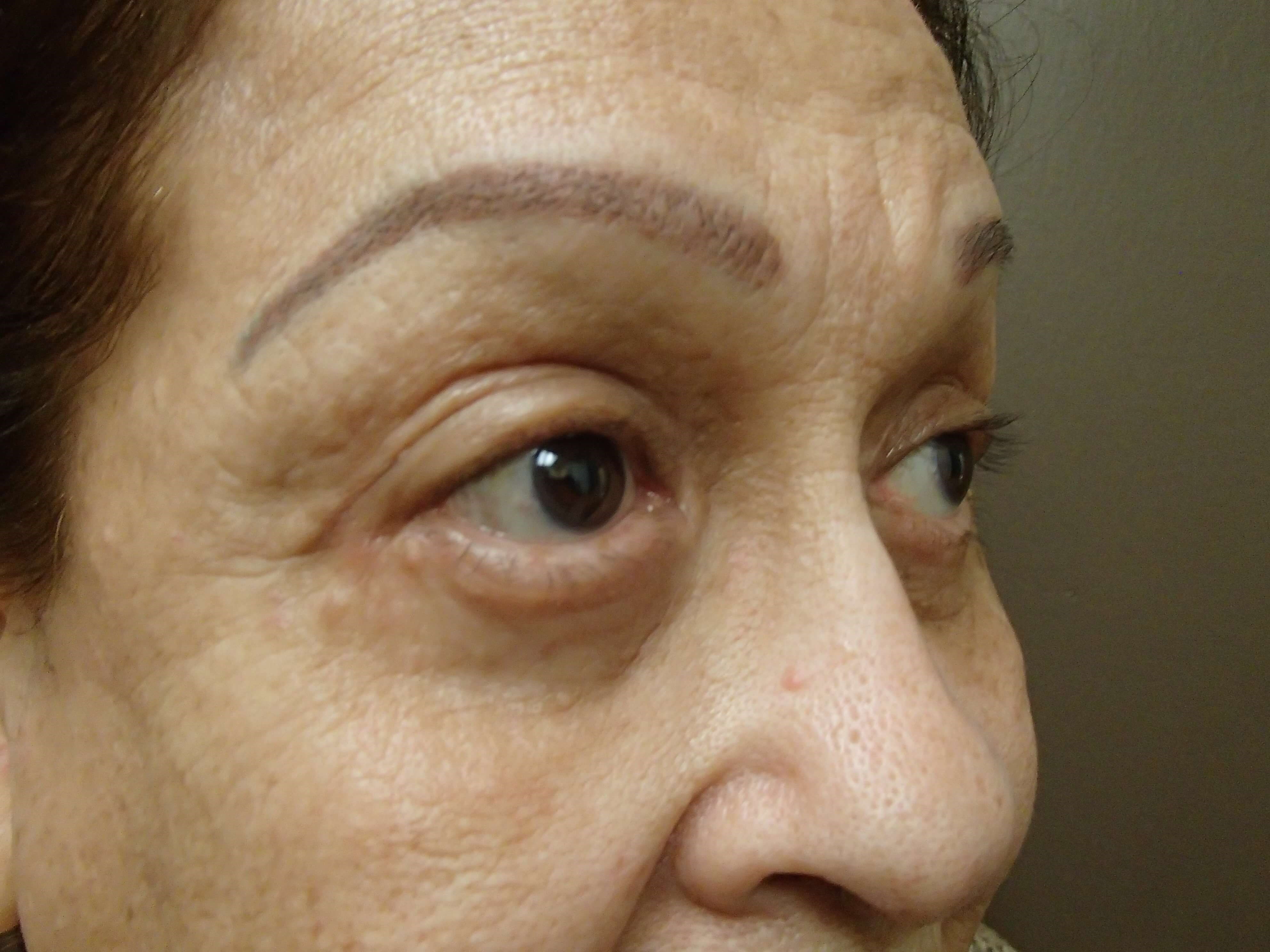 Blepharoplasty After