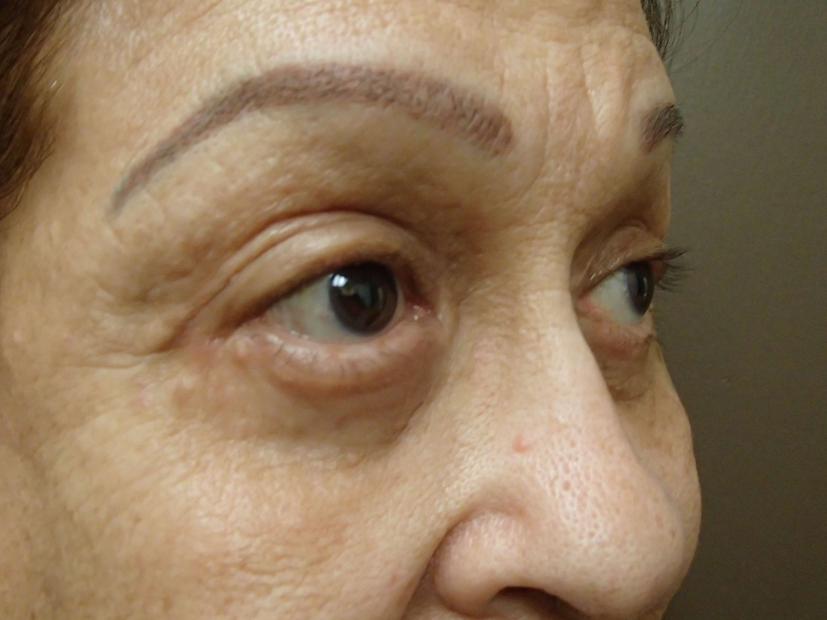 Blepharoplasty After