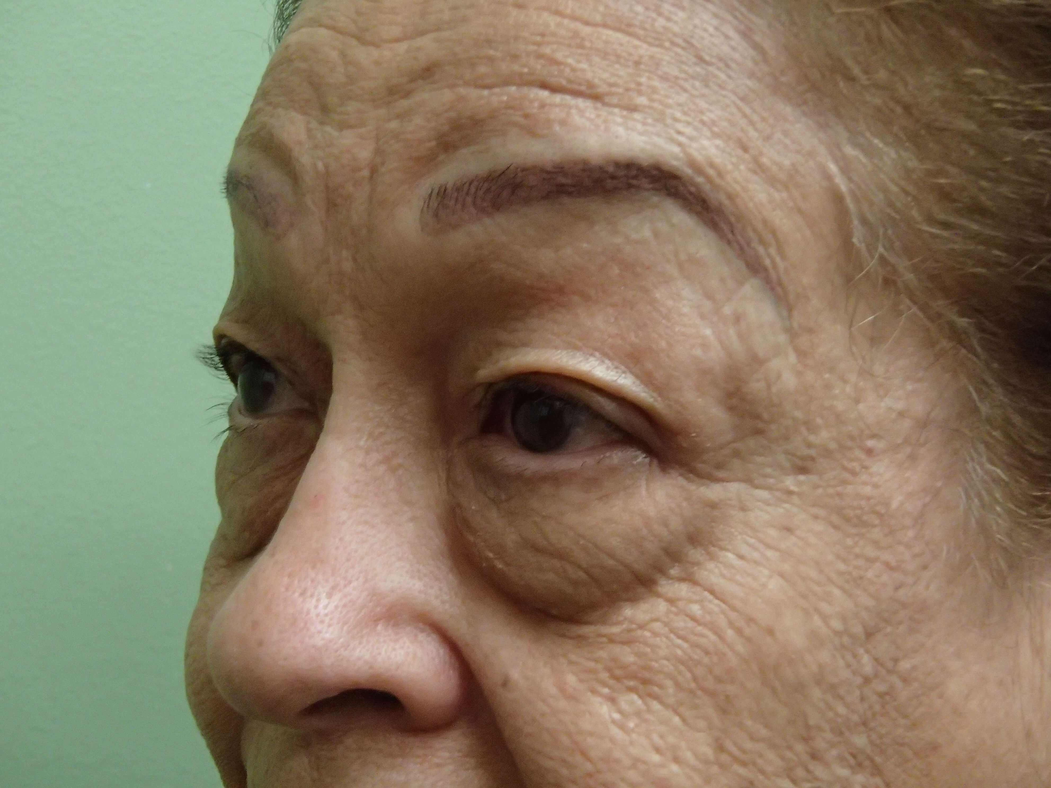 Blepharoplasty Before