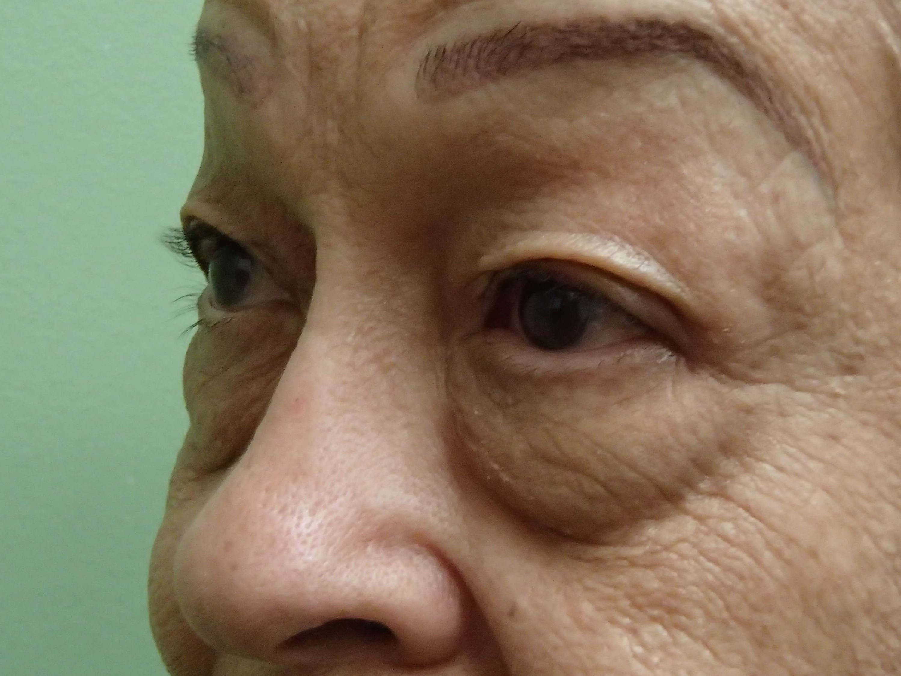 Blepharoplasty Before