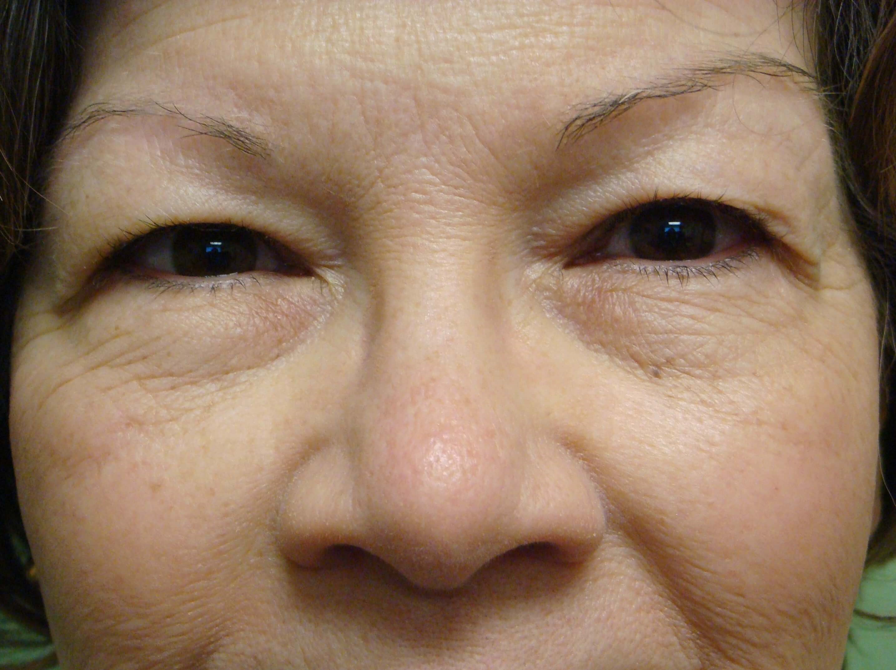 Blepharoplasty Before