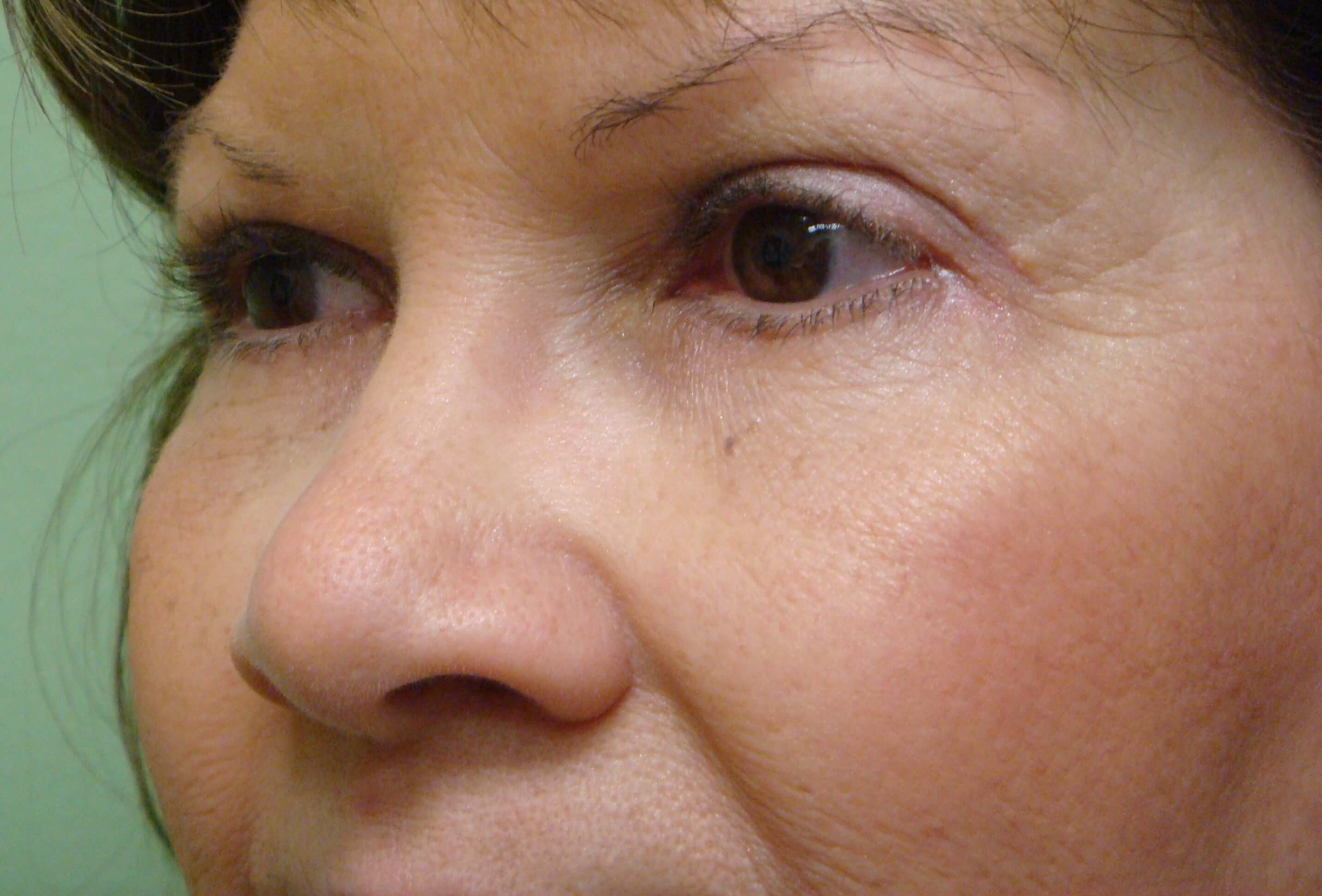Blepharoplasty After