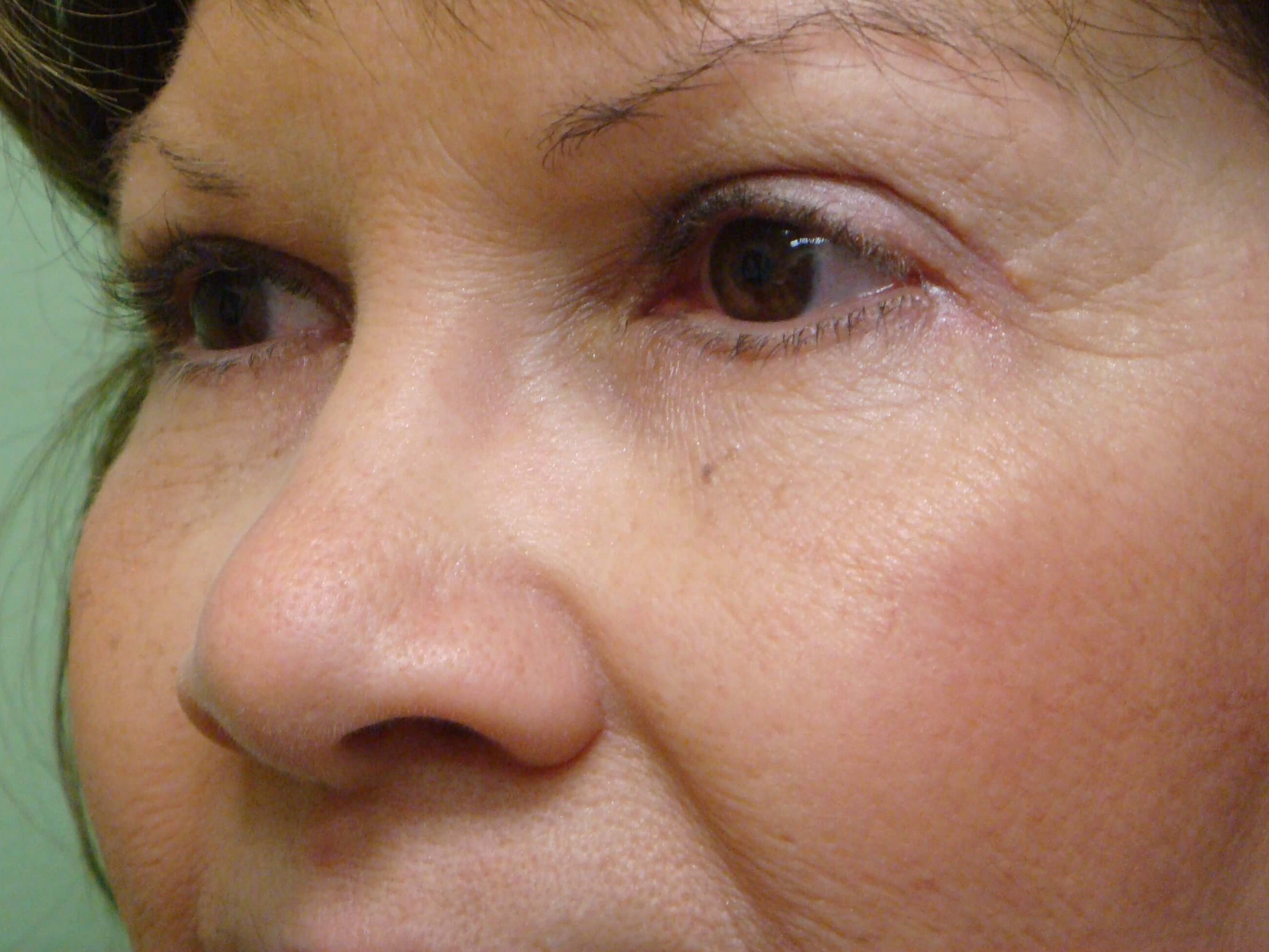 Blepharoplasty After