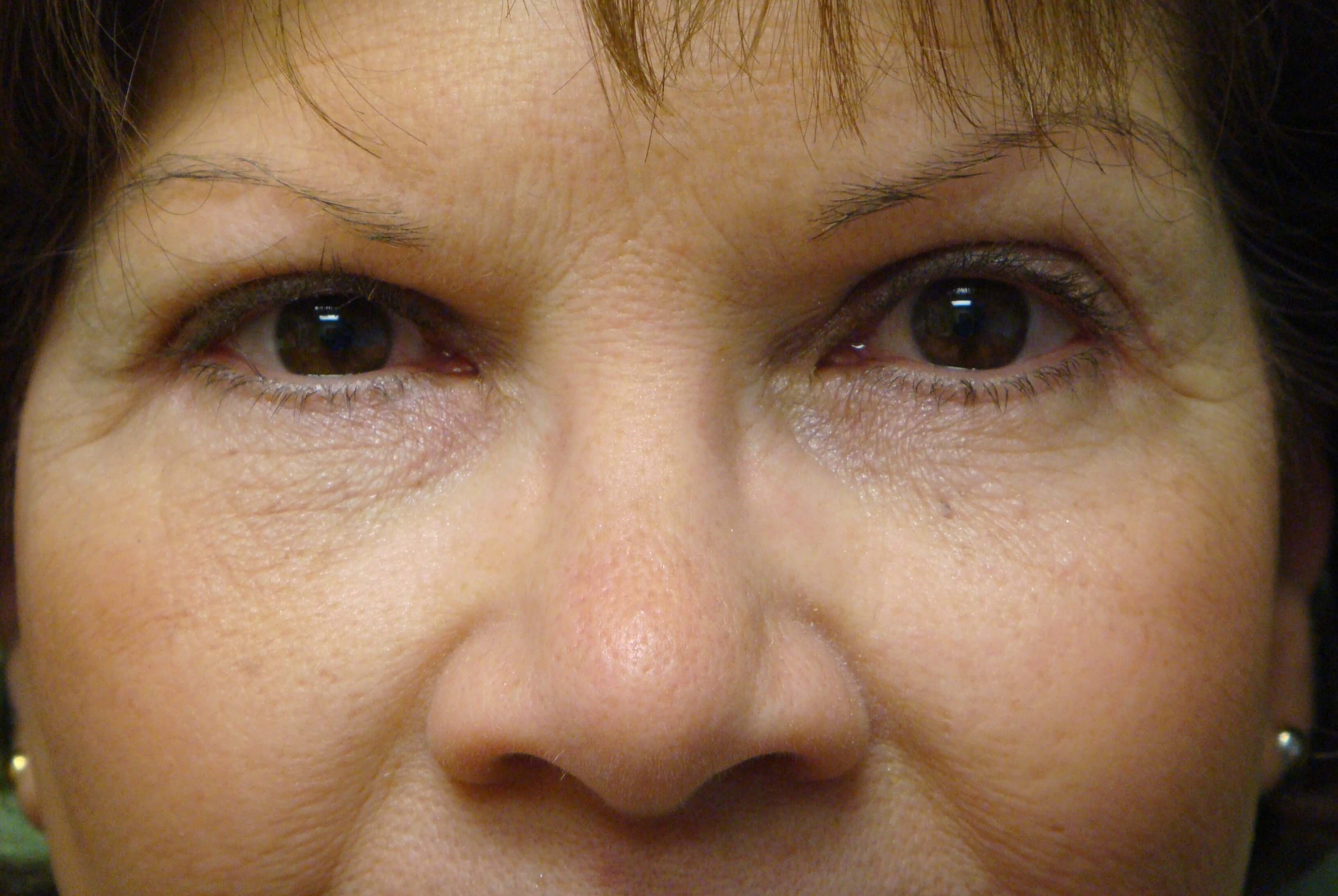 Blepharoplasty After