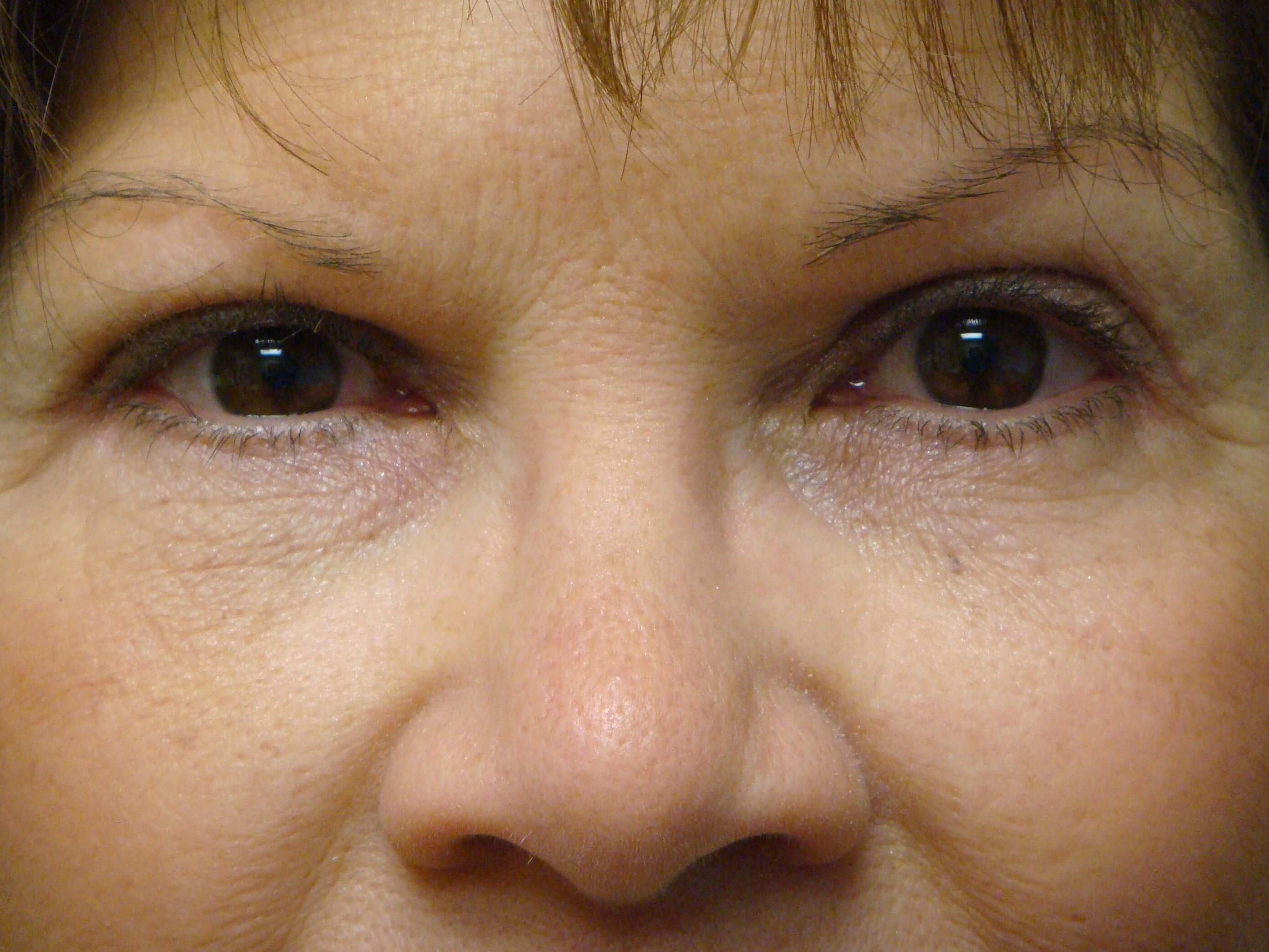 Blepharoplasty After
