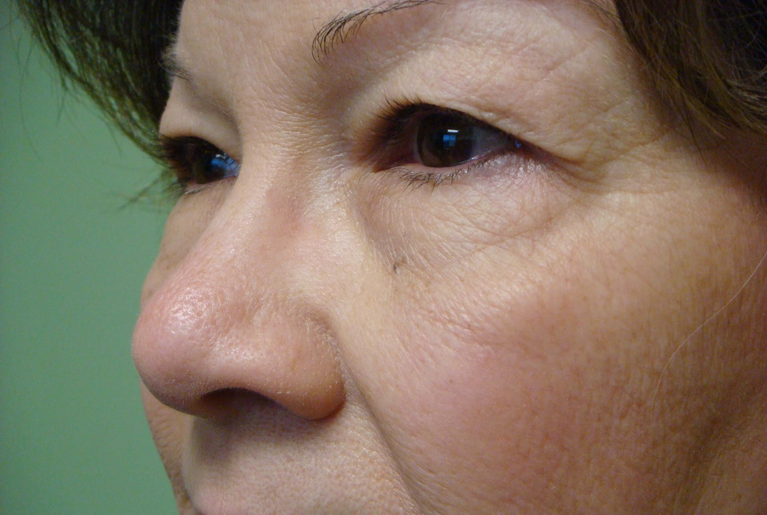 Blepharoplasty Before