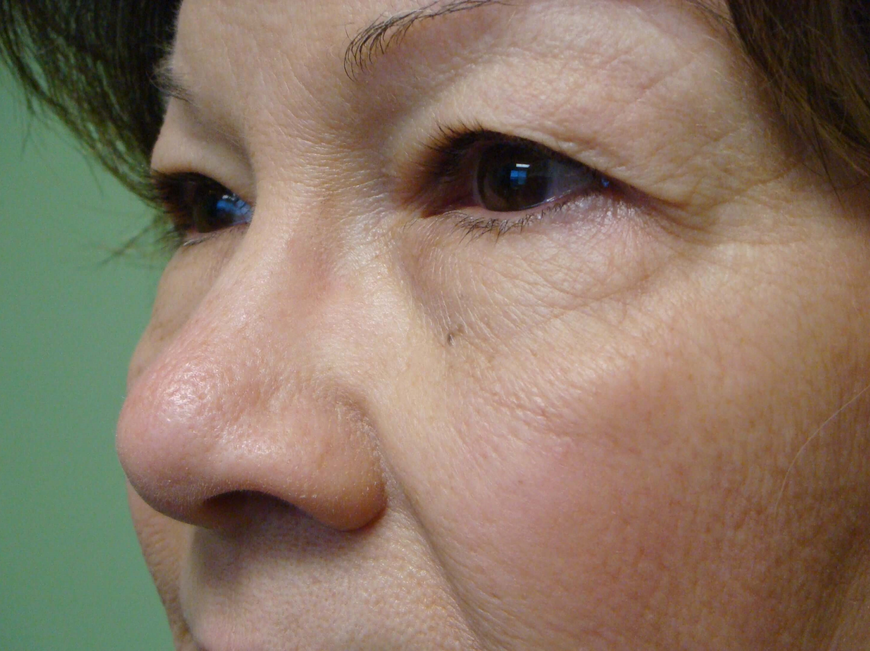 Blepharoplasty Before