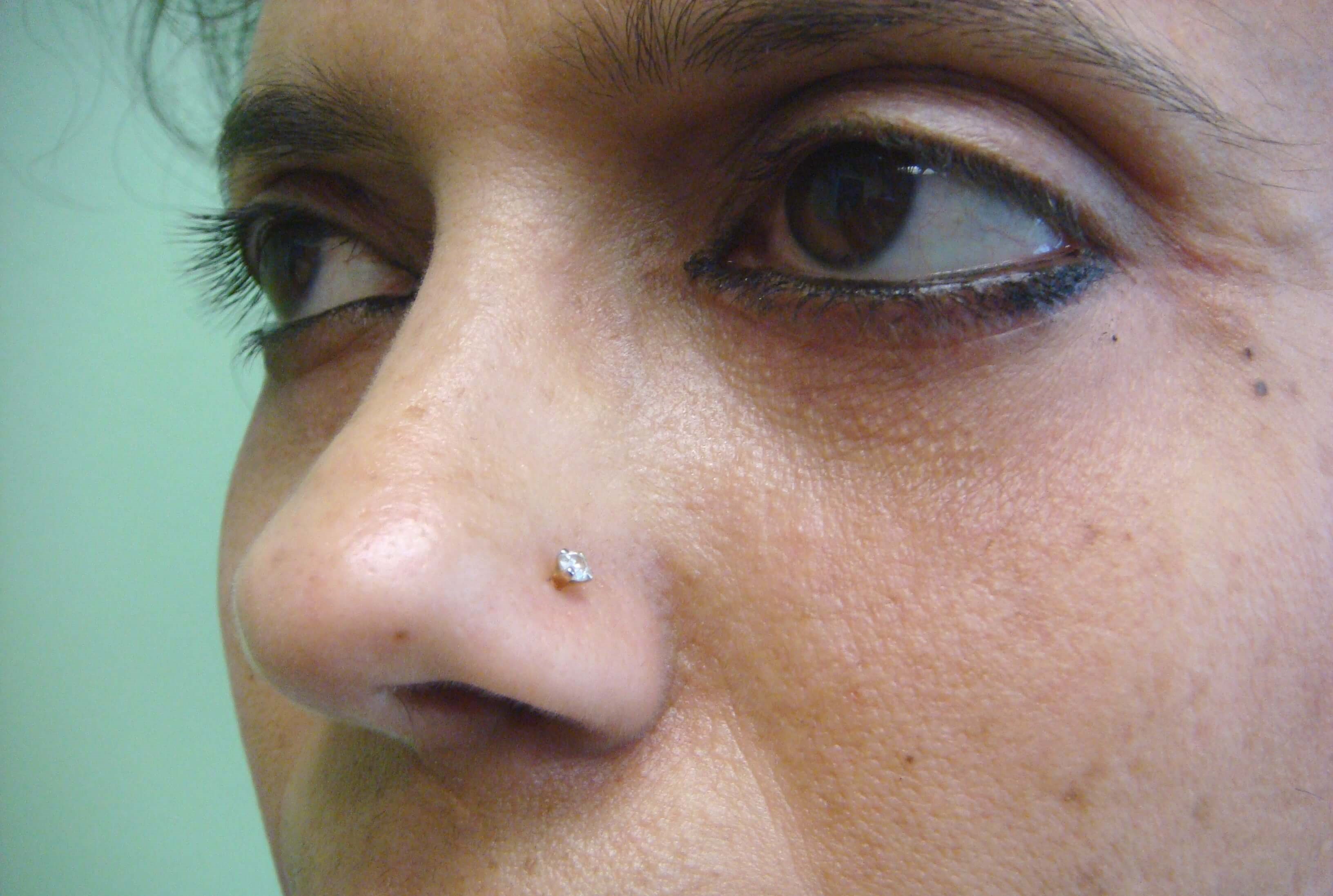 Blepharoplasty After