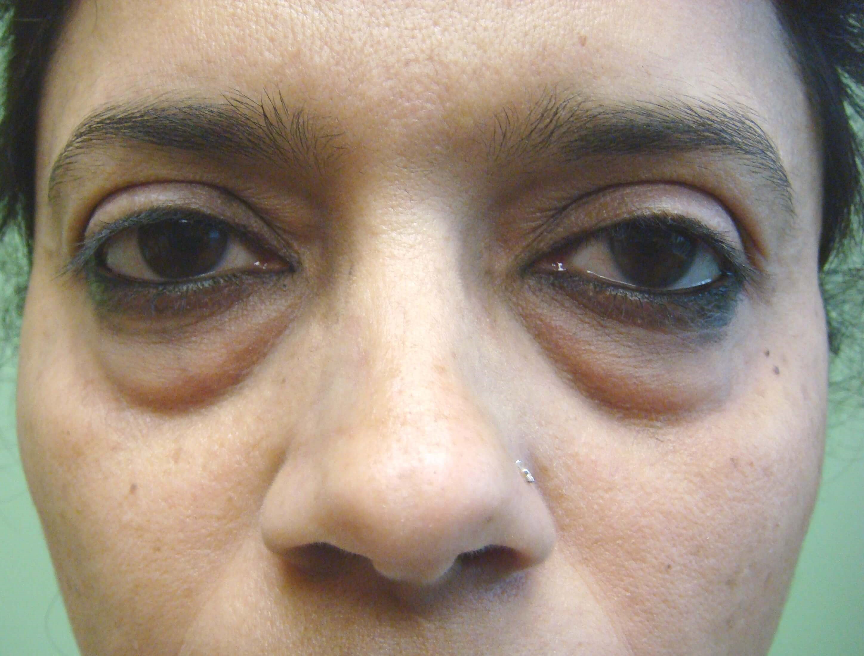 Blepharoplasty Before