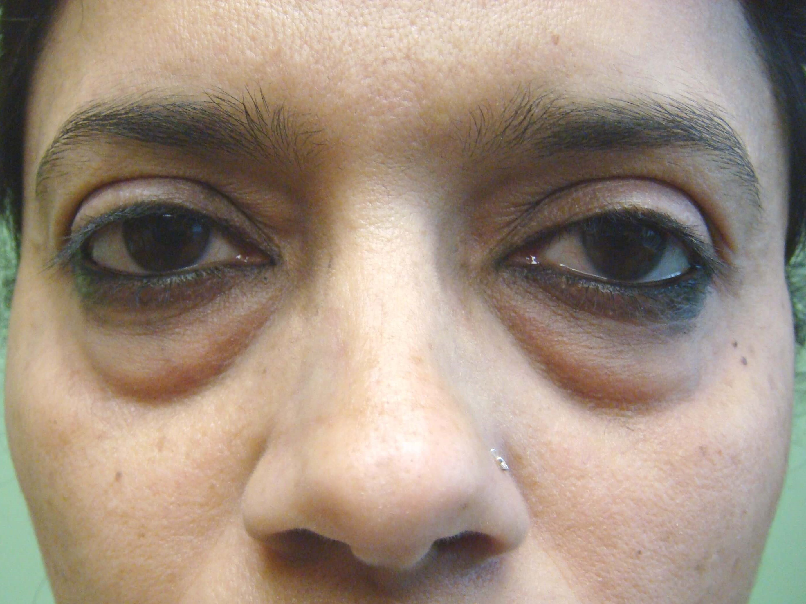 Blepharoplasty Before