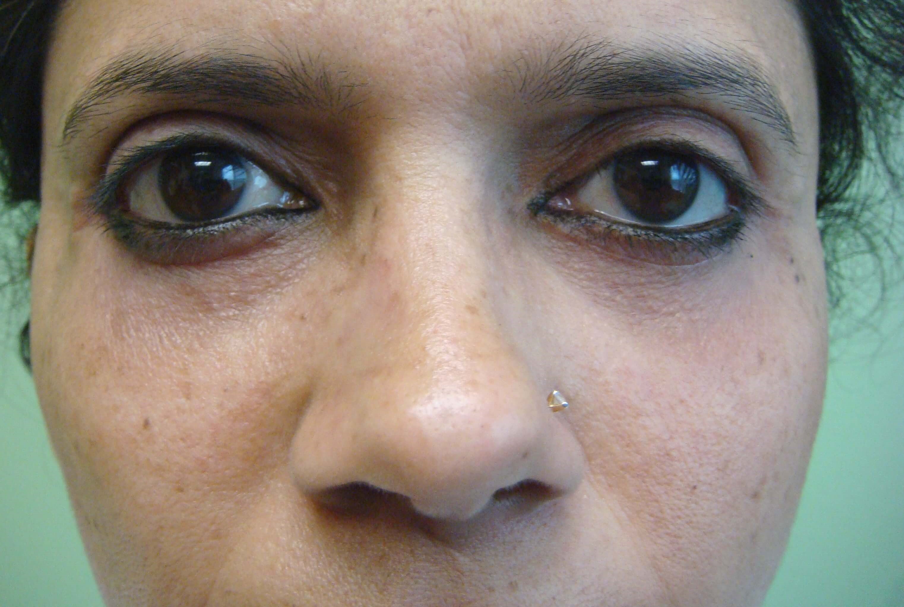 Blepharoplasty After