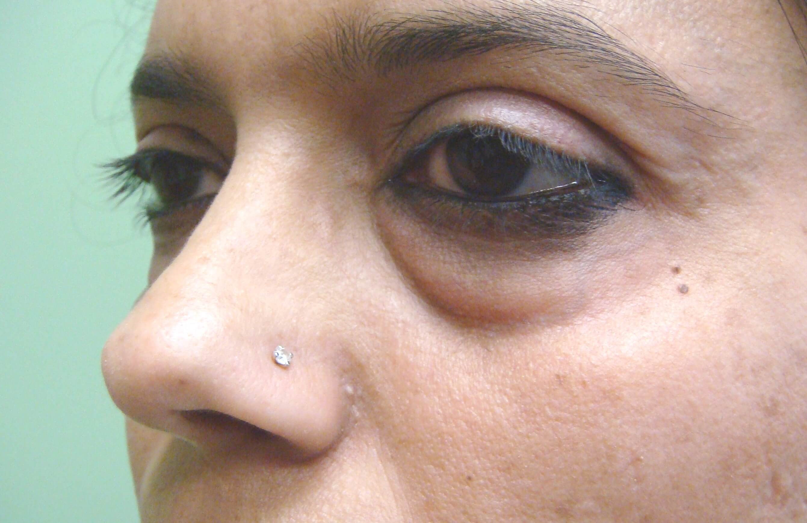 Blepharoplasty Before