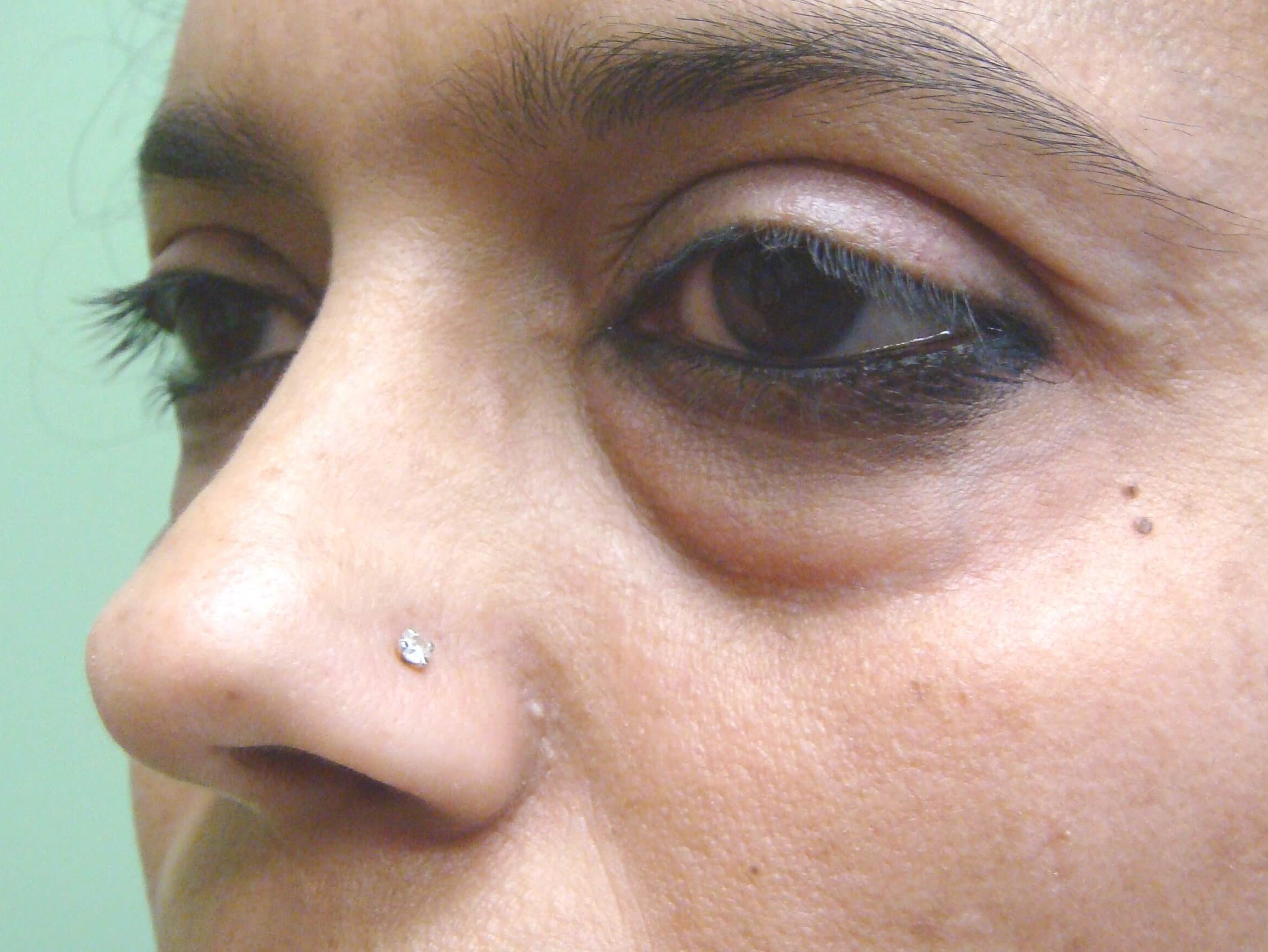 Blepharoplasty Before