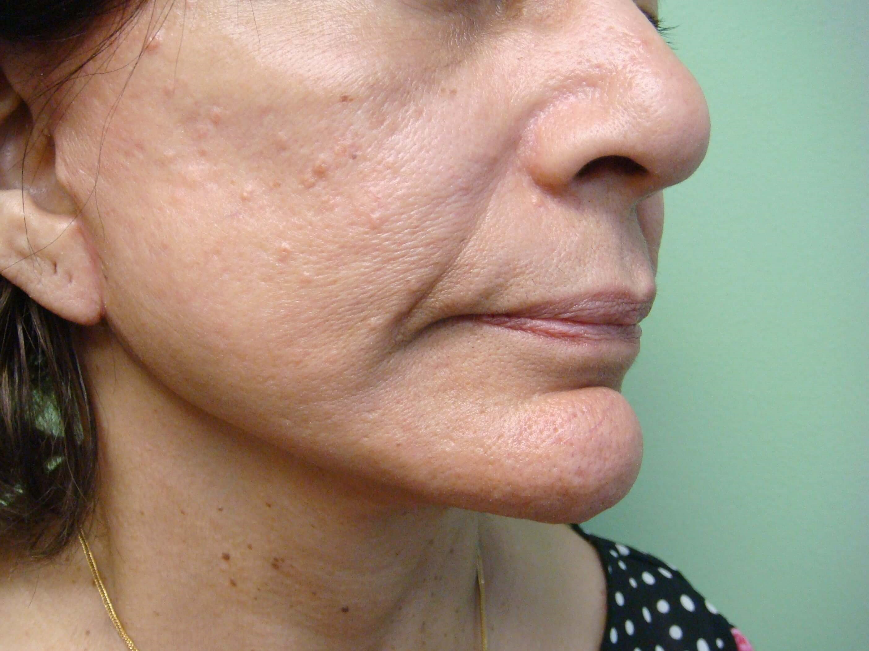 Facelift After