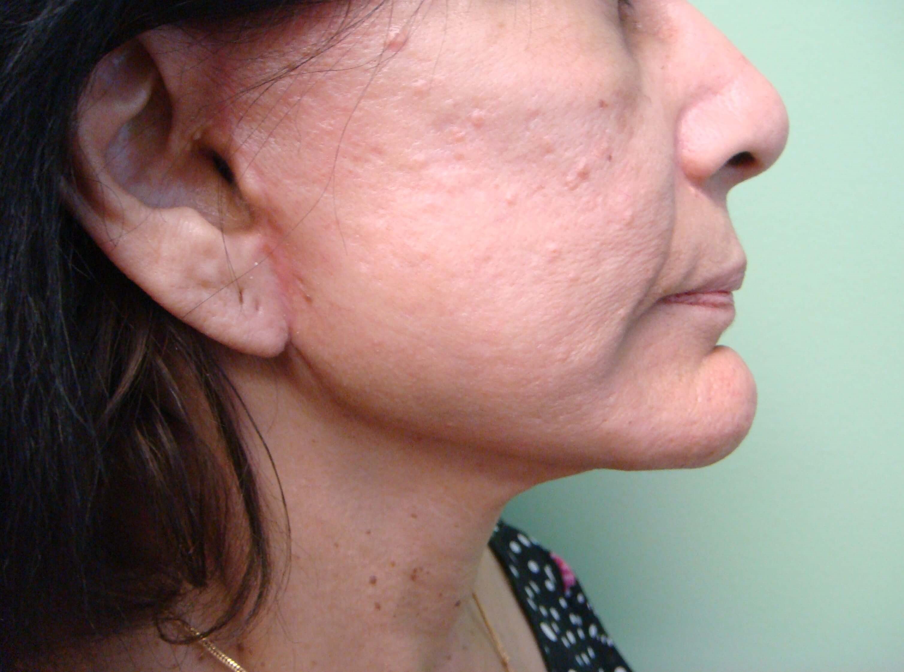 Facelift After