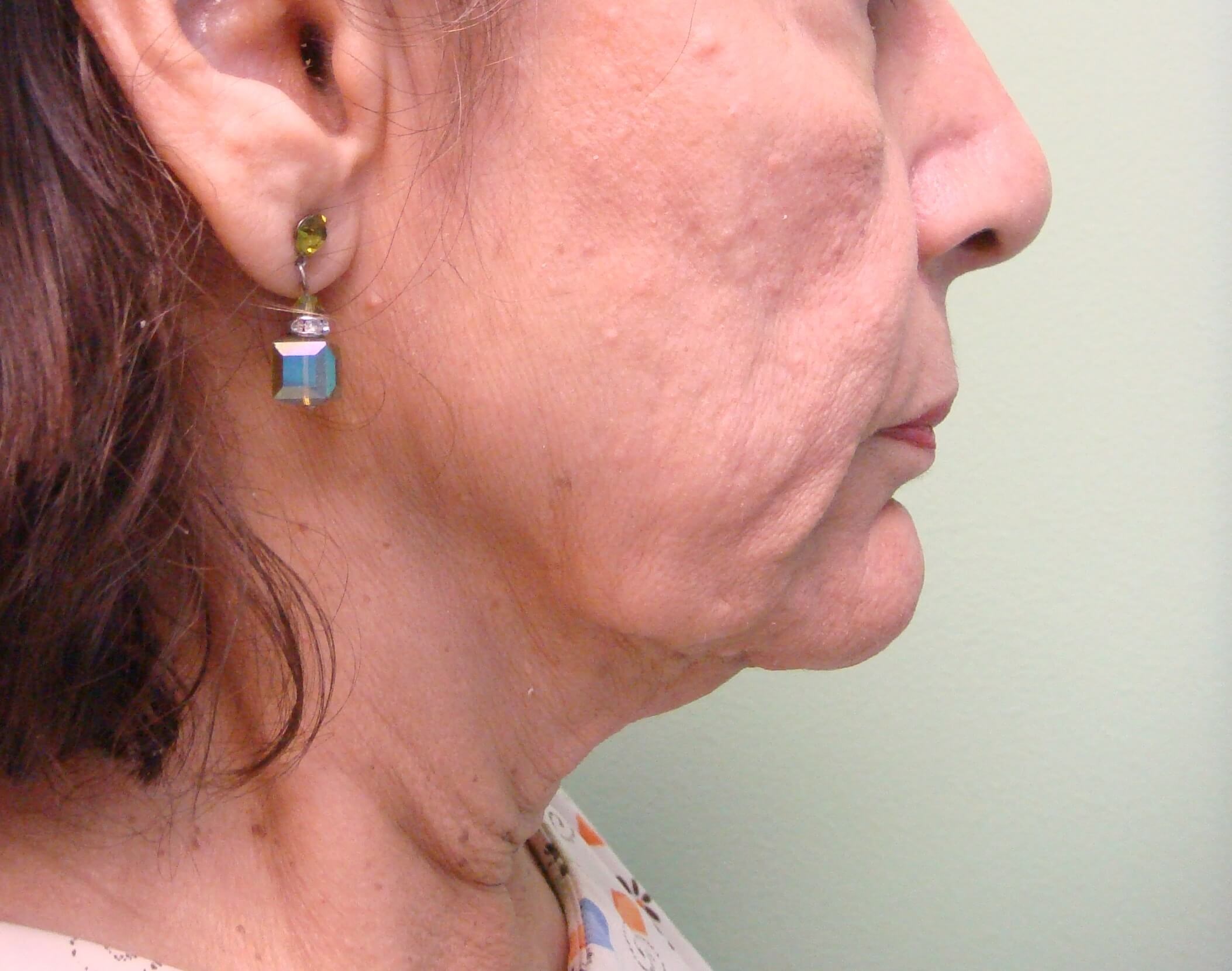 Facelift Before