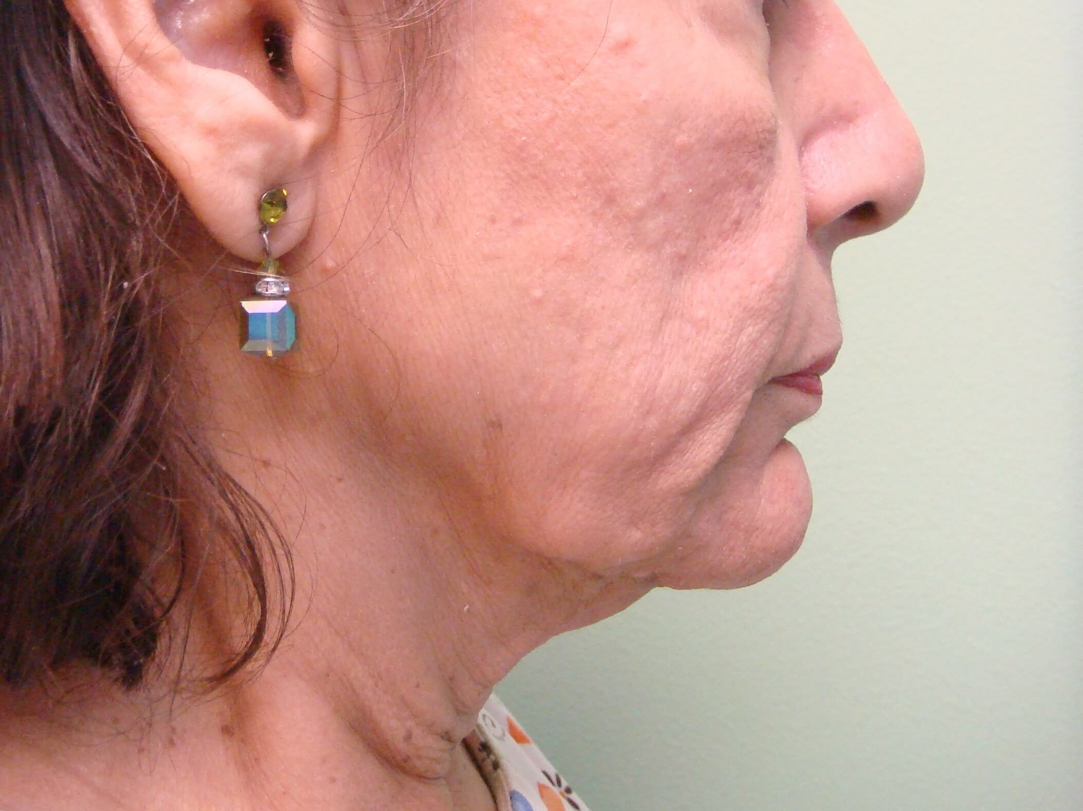 Facelift Before