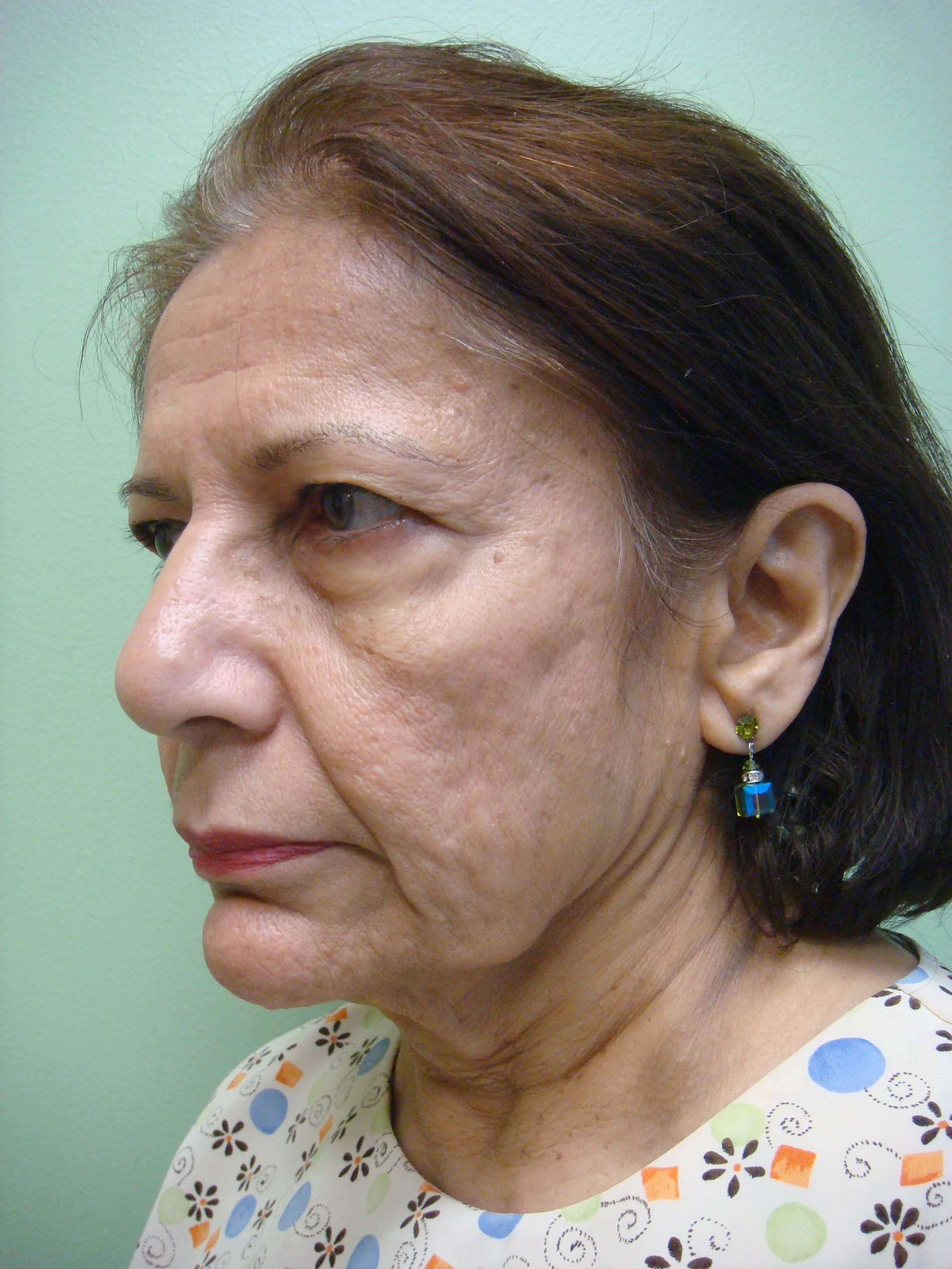 Facelift Before