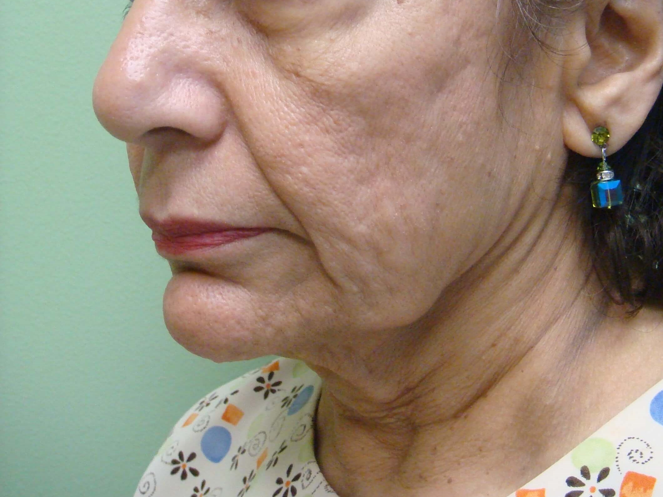 Facelift Before