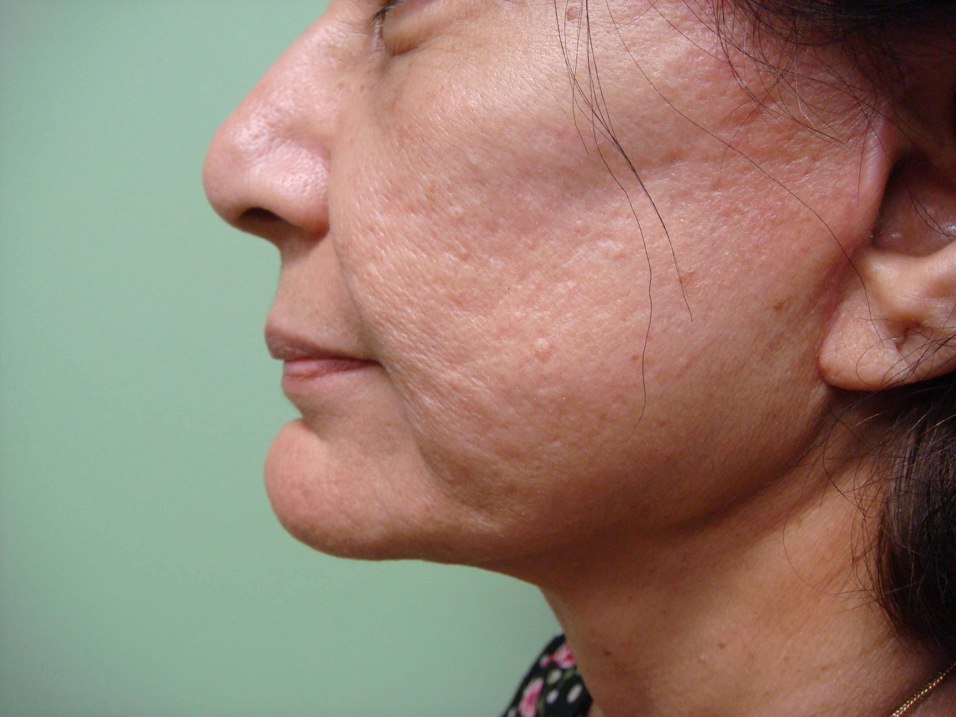 Facelift After