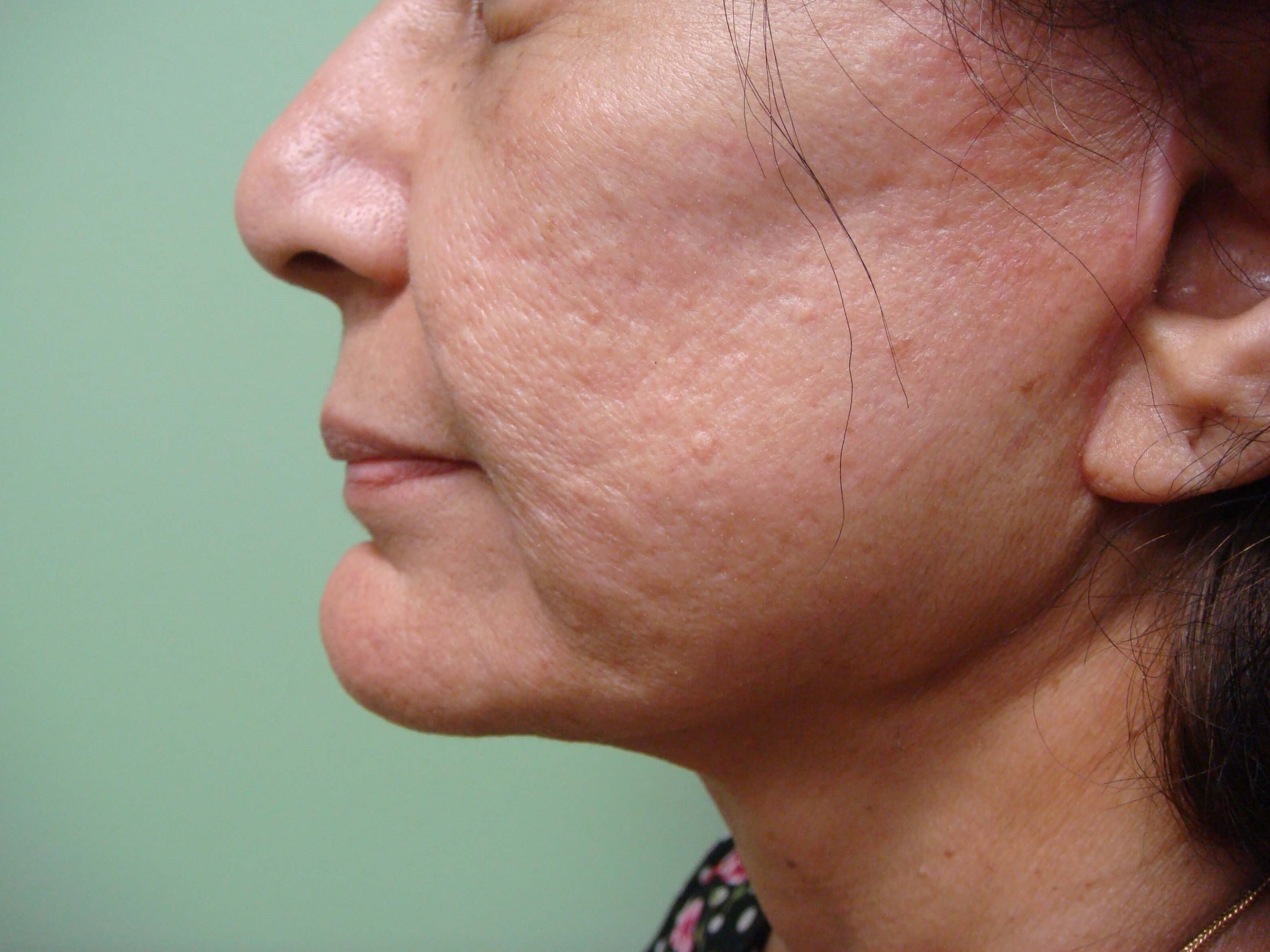 Facelift After