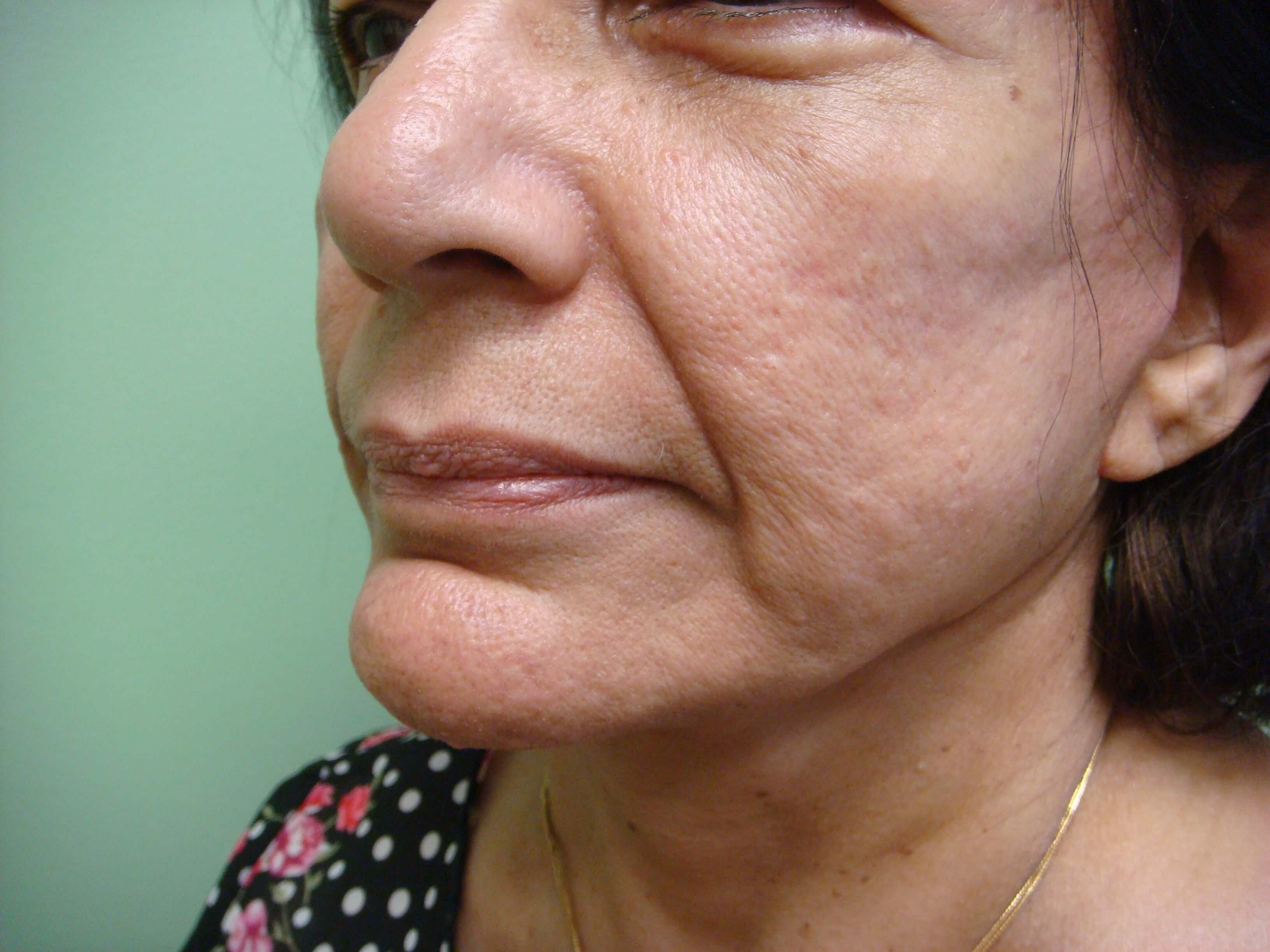 Facelift After
