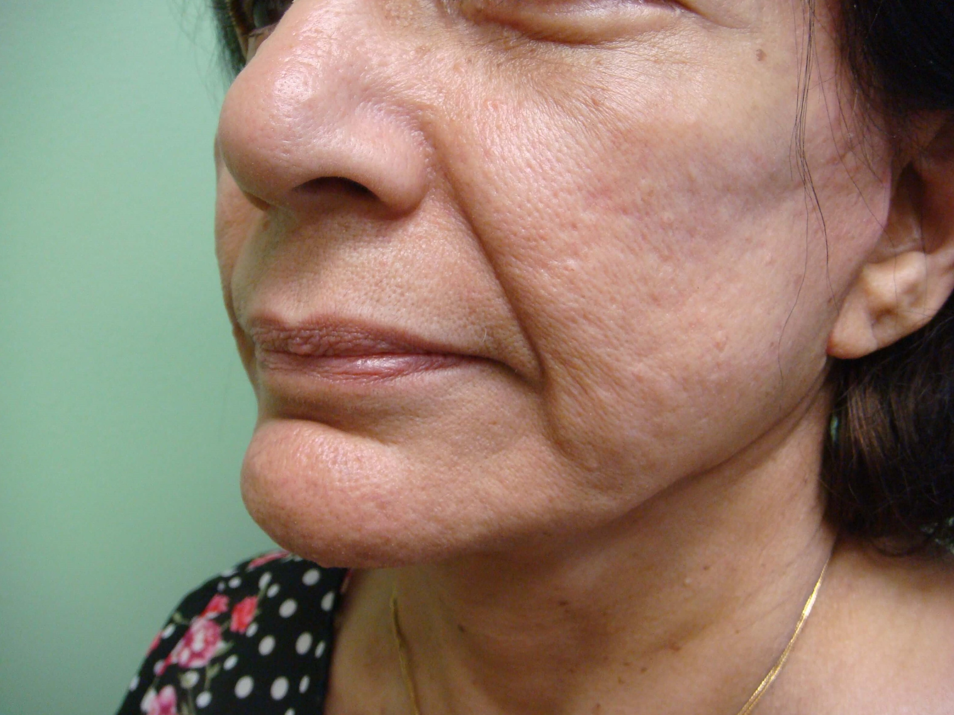 Facelift After