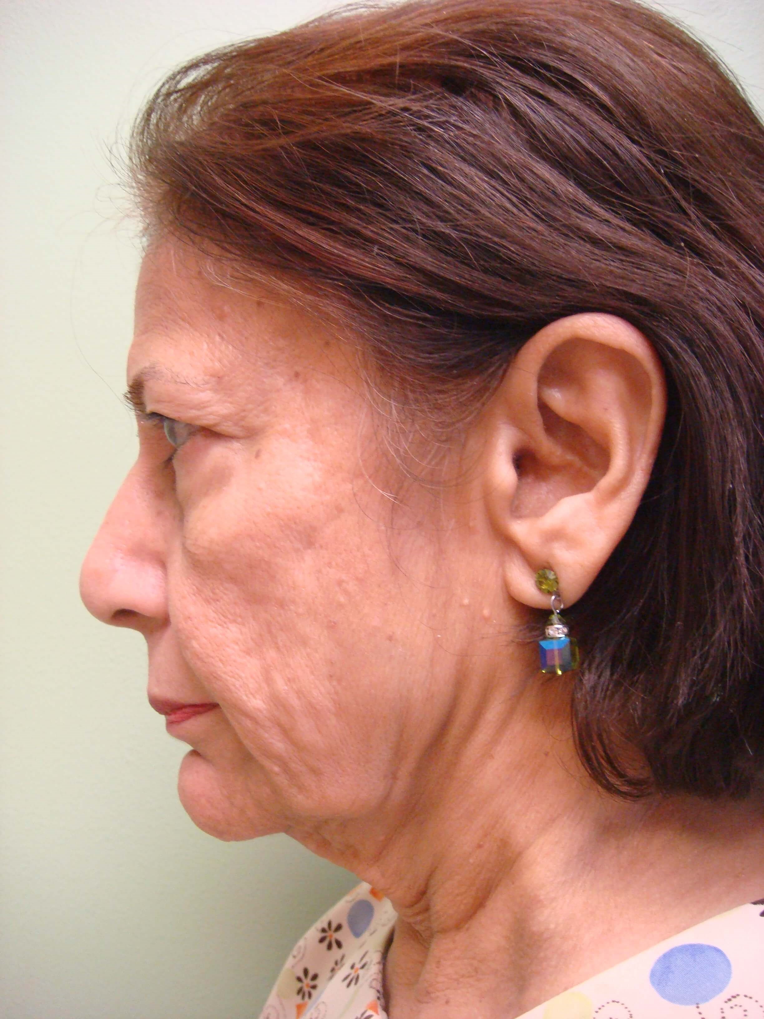 Facelift Before