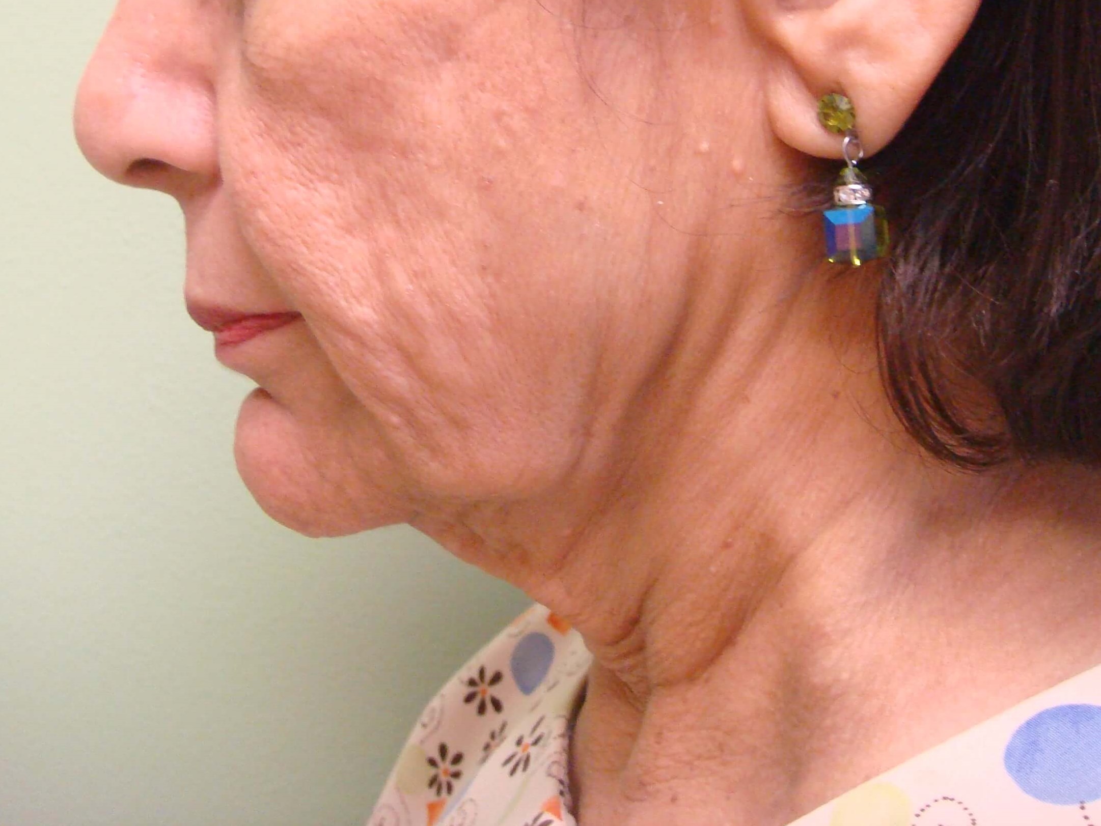 Facelift Before