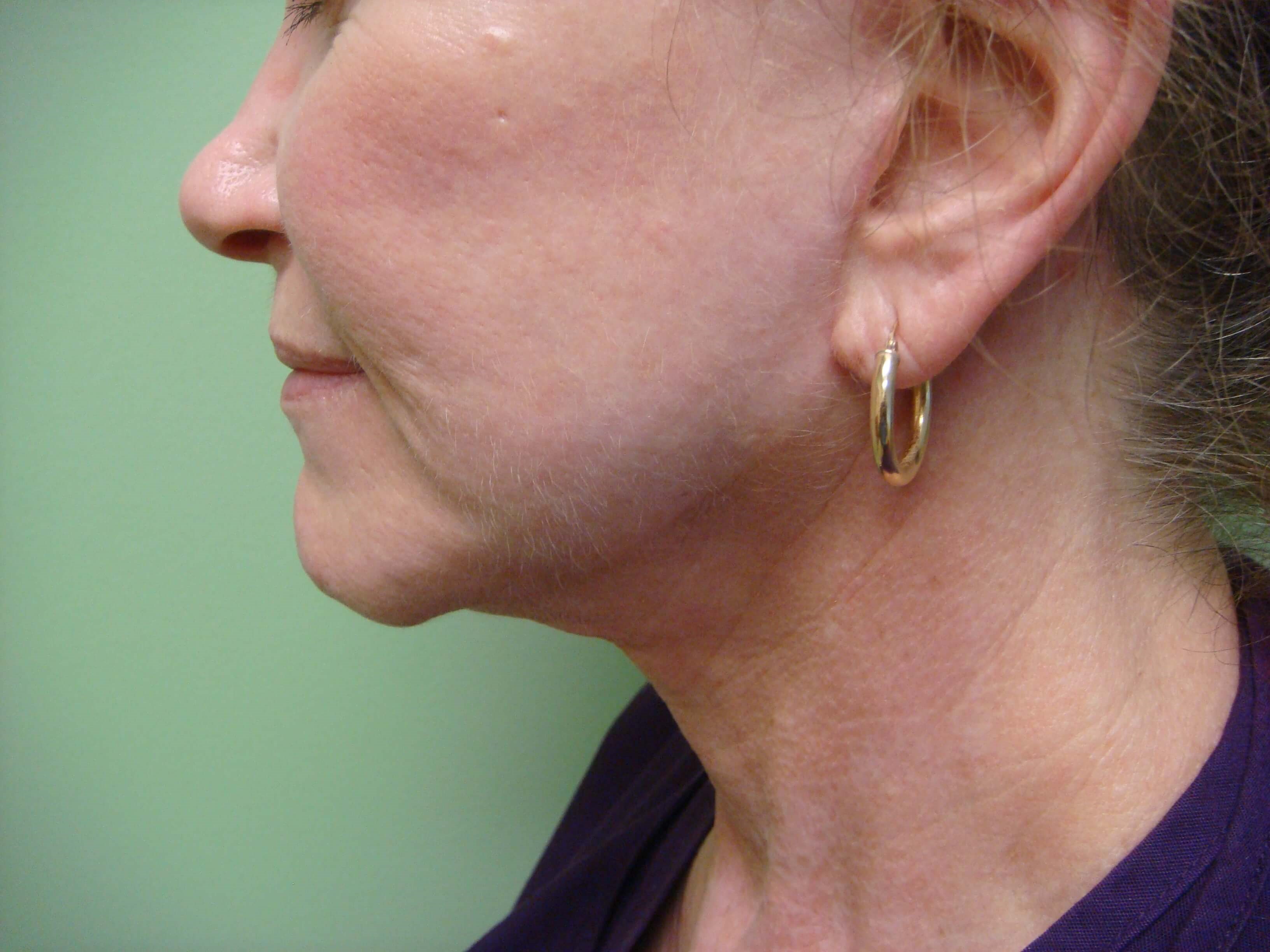 Facelift with Necklift After
