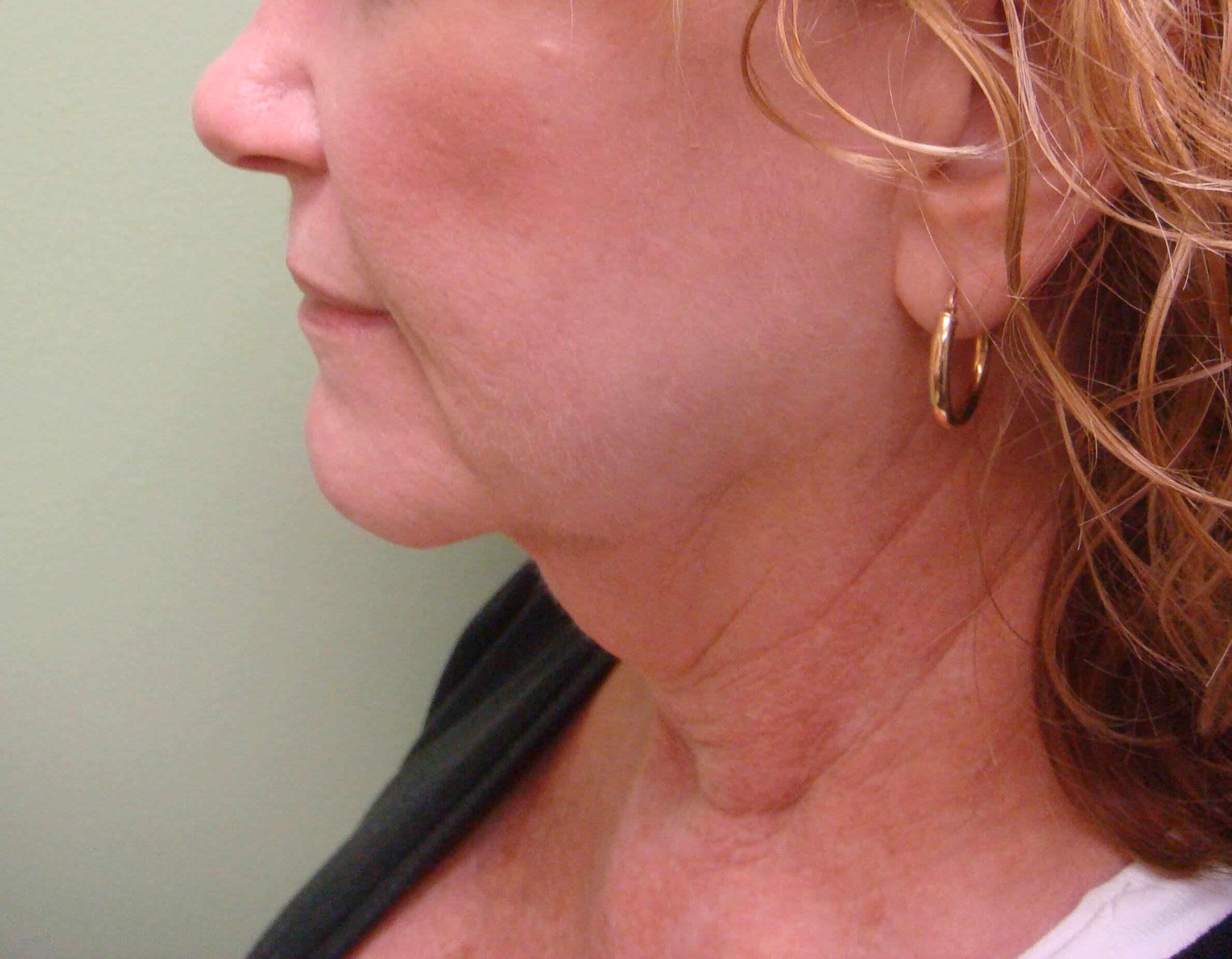 Facelift with Necklift Before