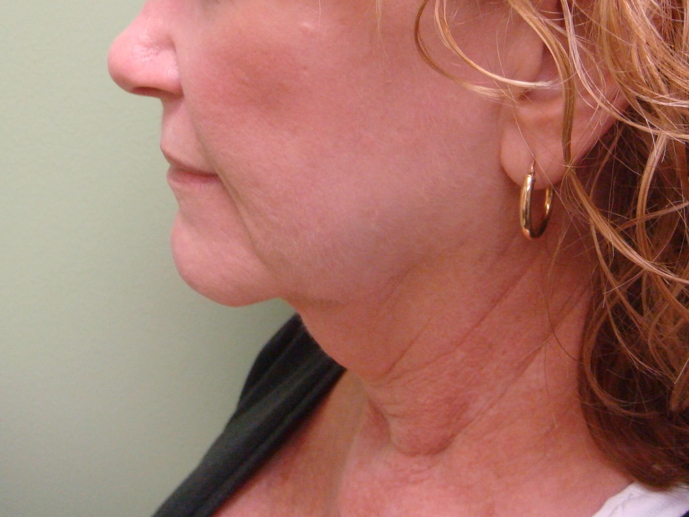 Facelift with Necklift Before