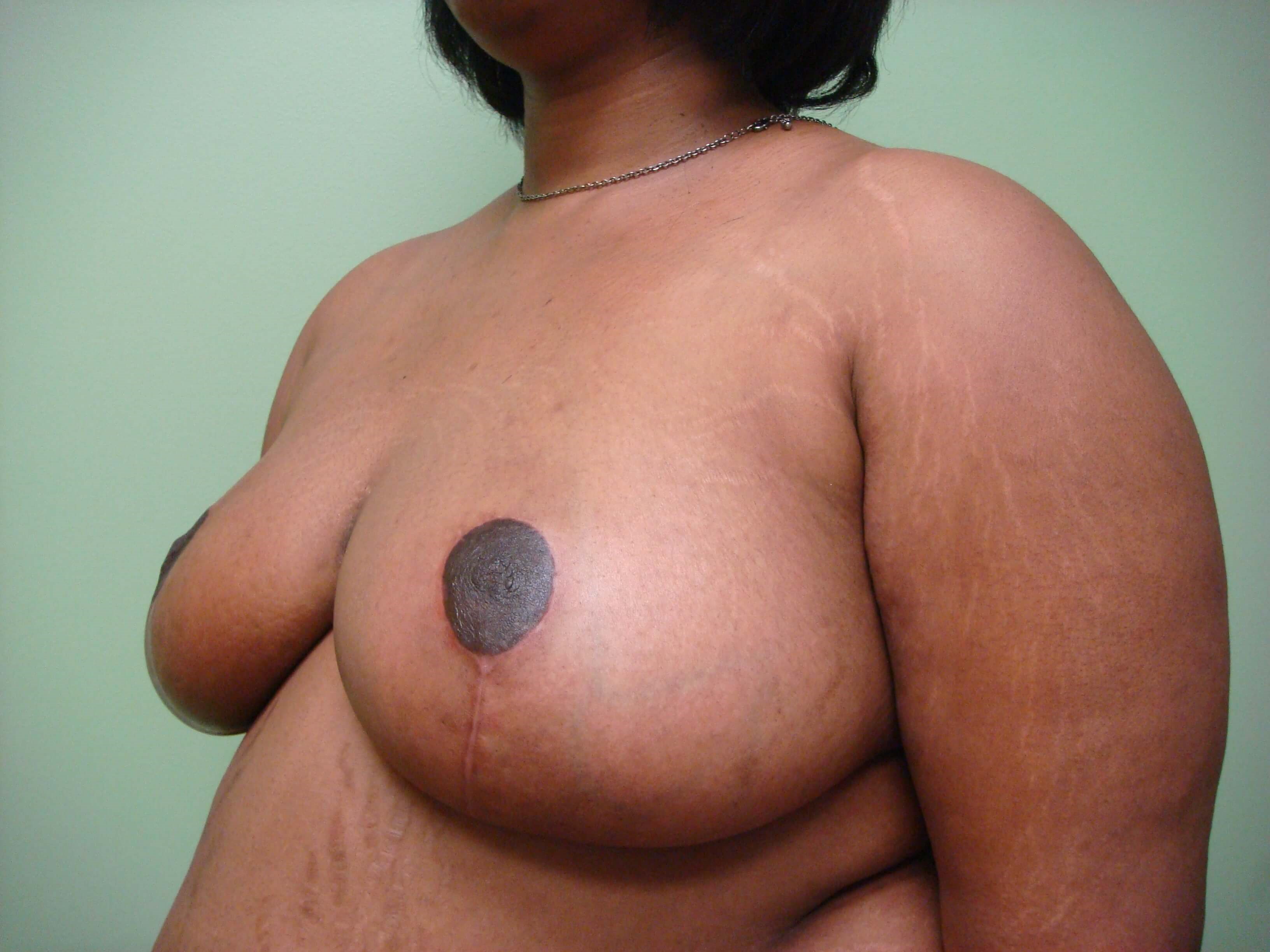 Cosmetic Breast Reduction After