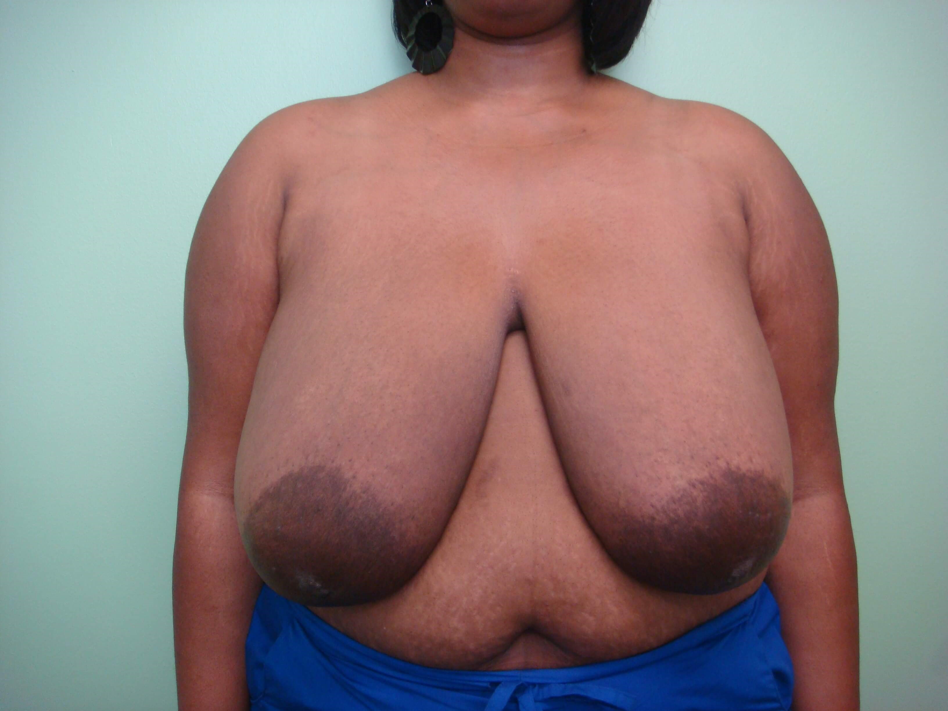 Cosmetic Breast Reduction Before