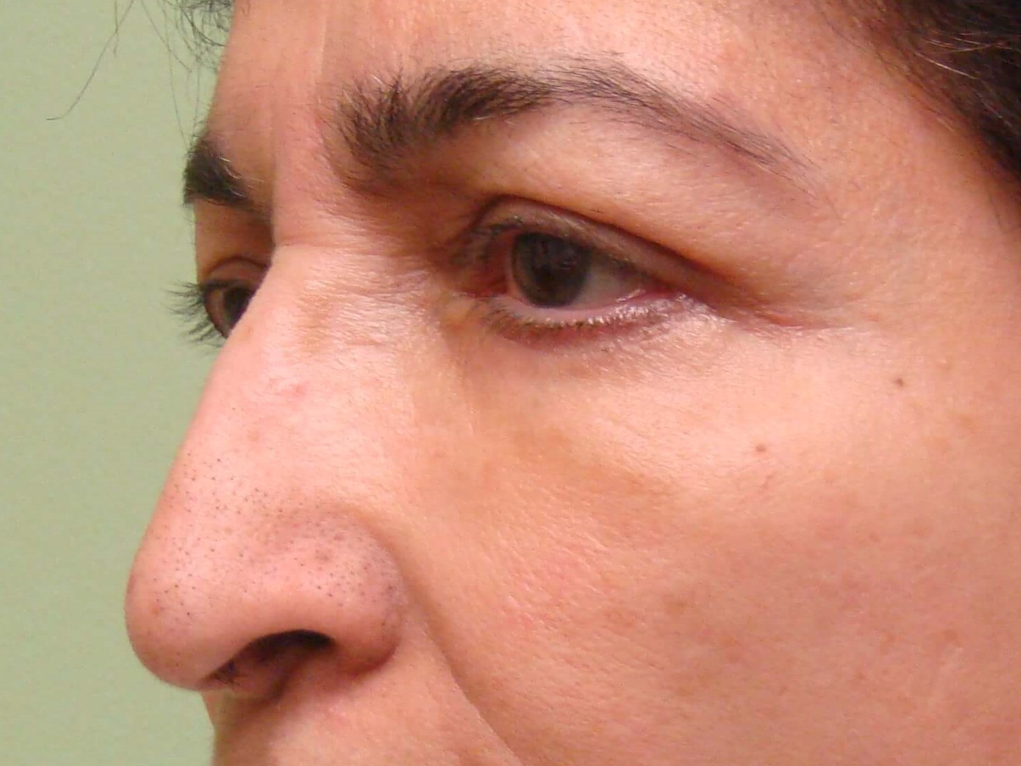 Upper/Lower Blepharoplasty After