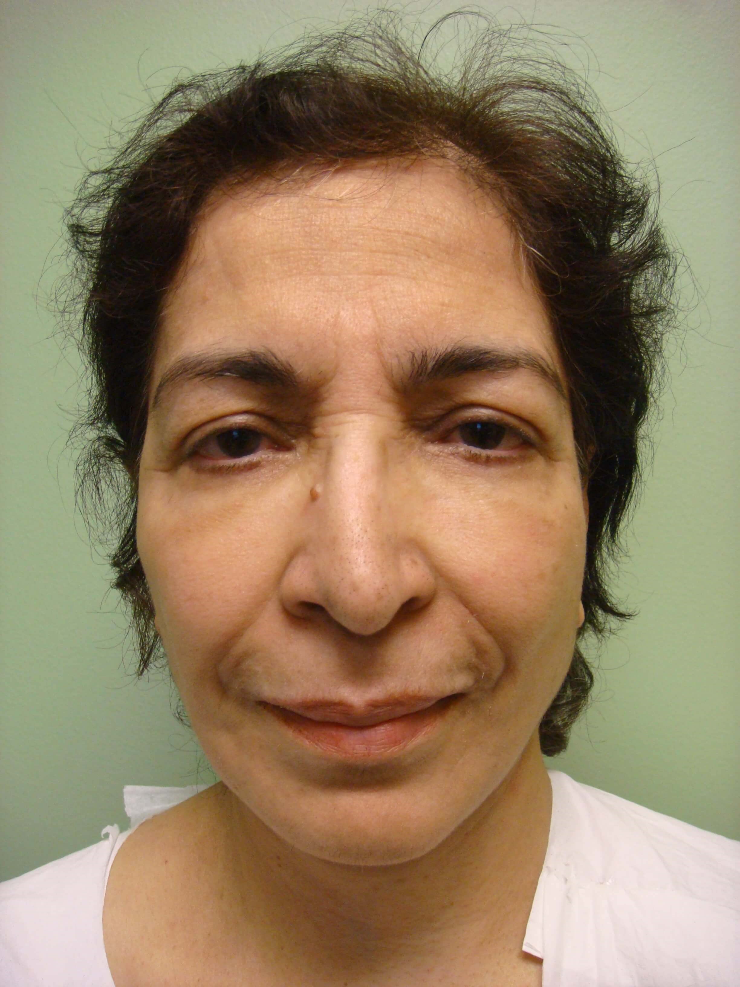 Upper/Lower Blepharoplasty After