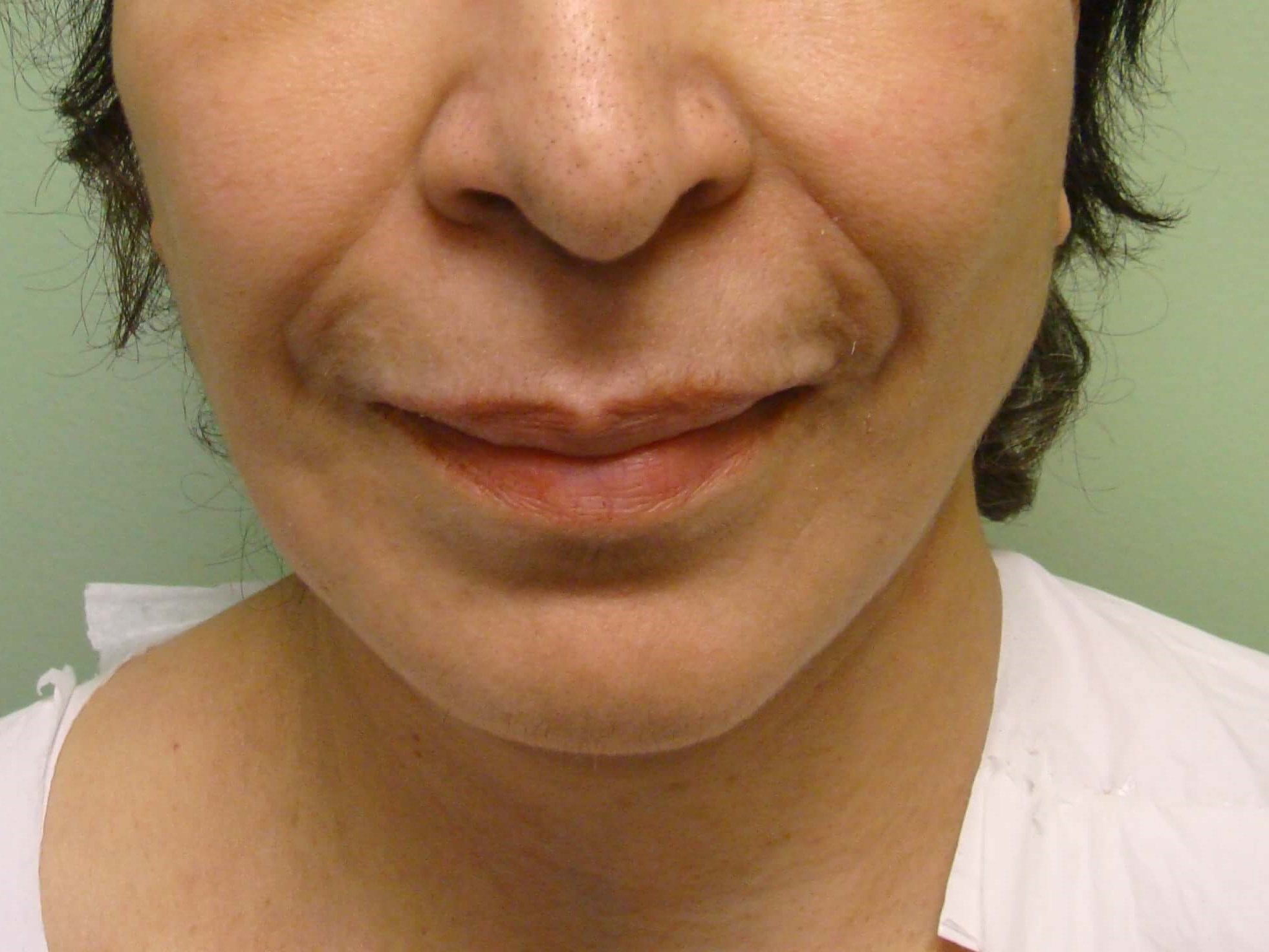Facelift with Necklift After