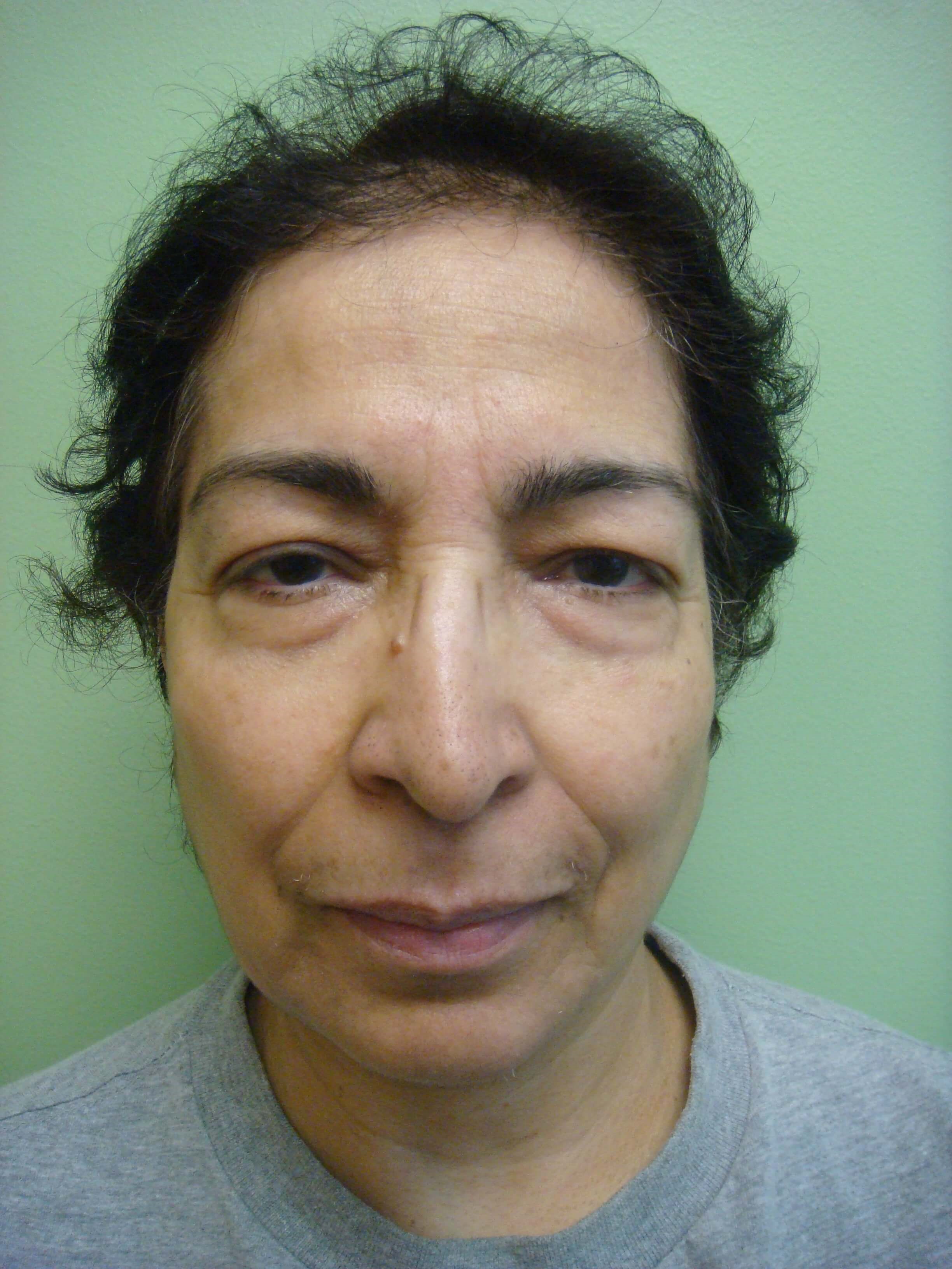 Upper/Lower Blepharoplasty Before