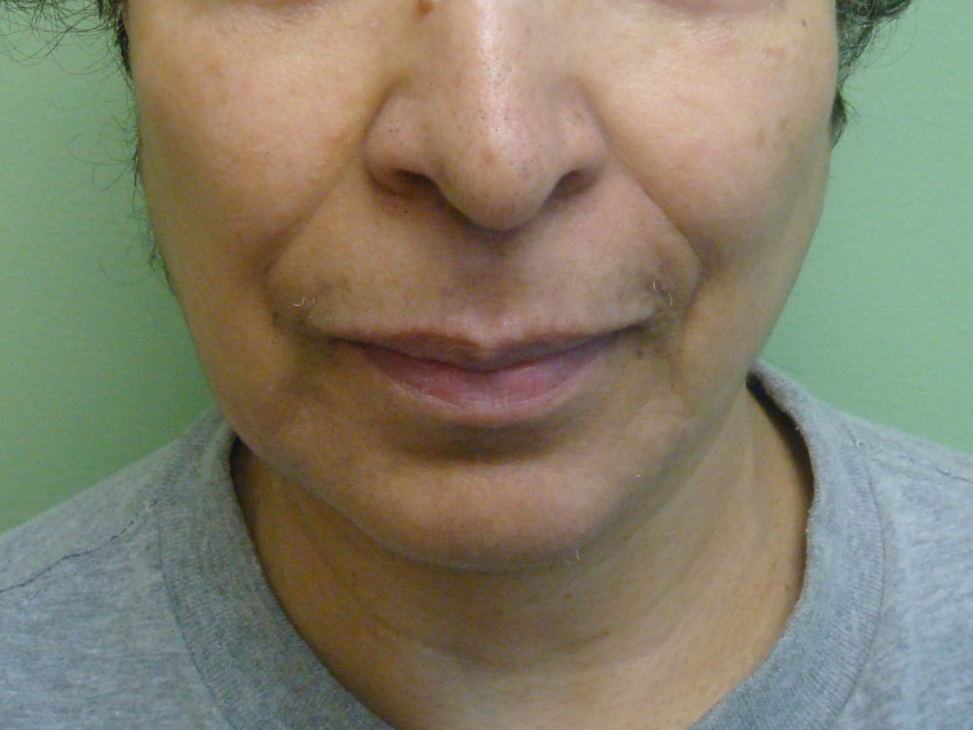 Facelift with Necklift Before