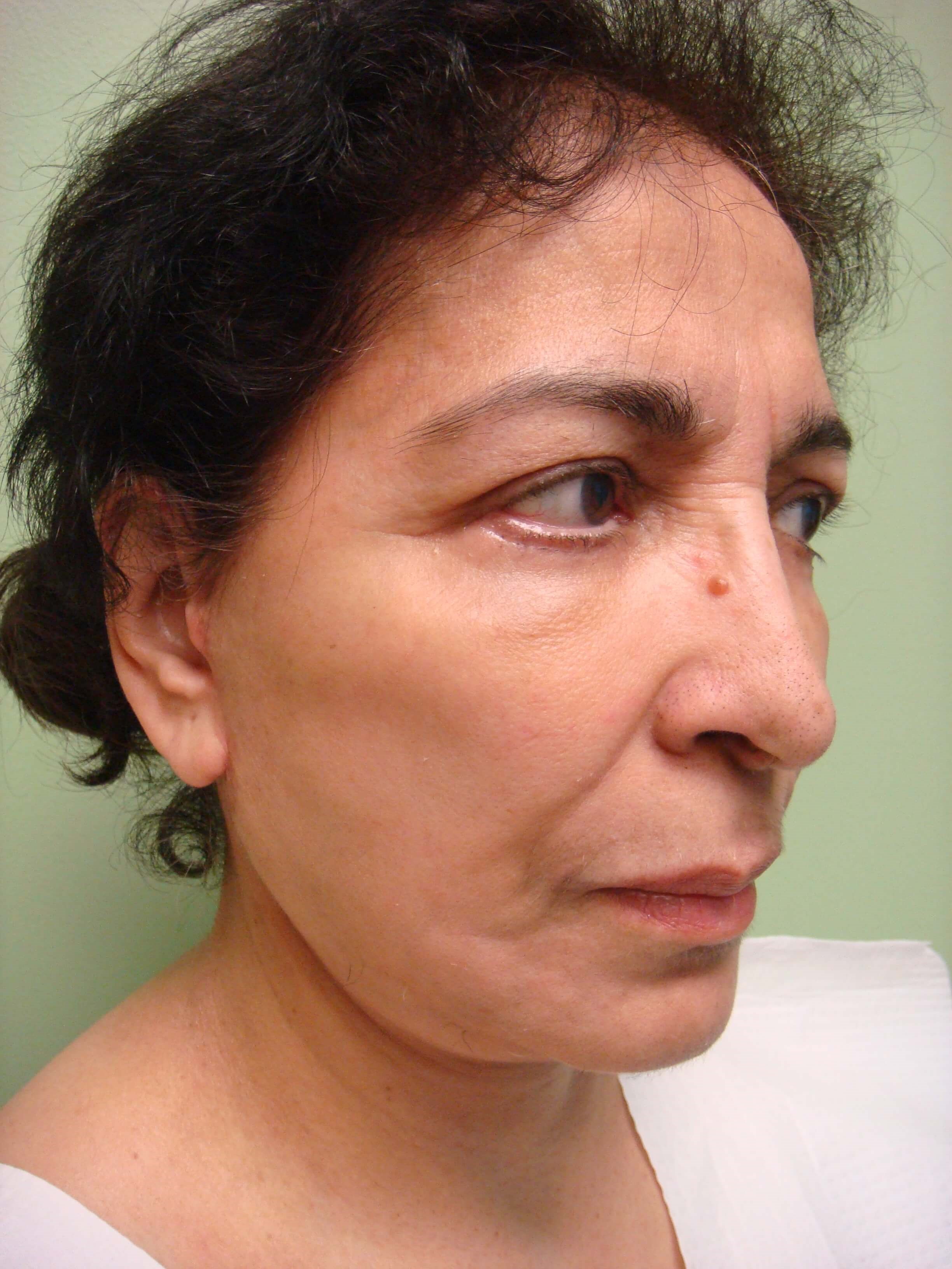 Upper/Lower Blepharoplasty After